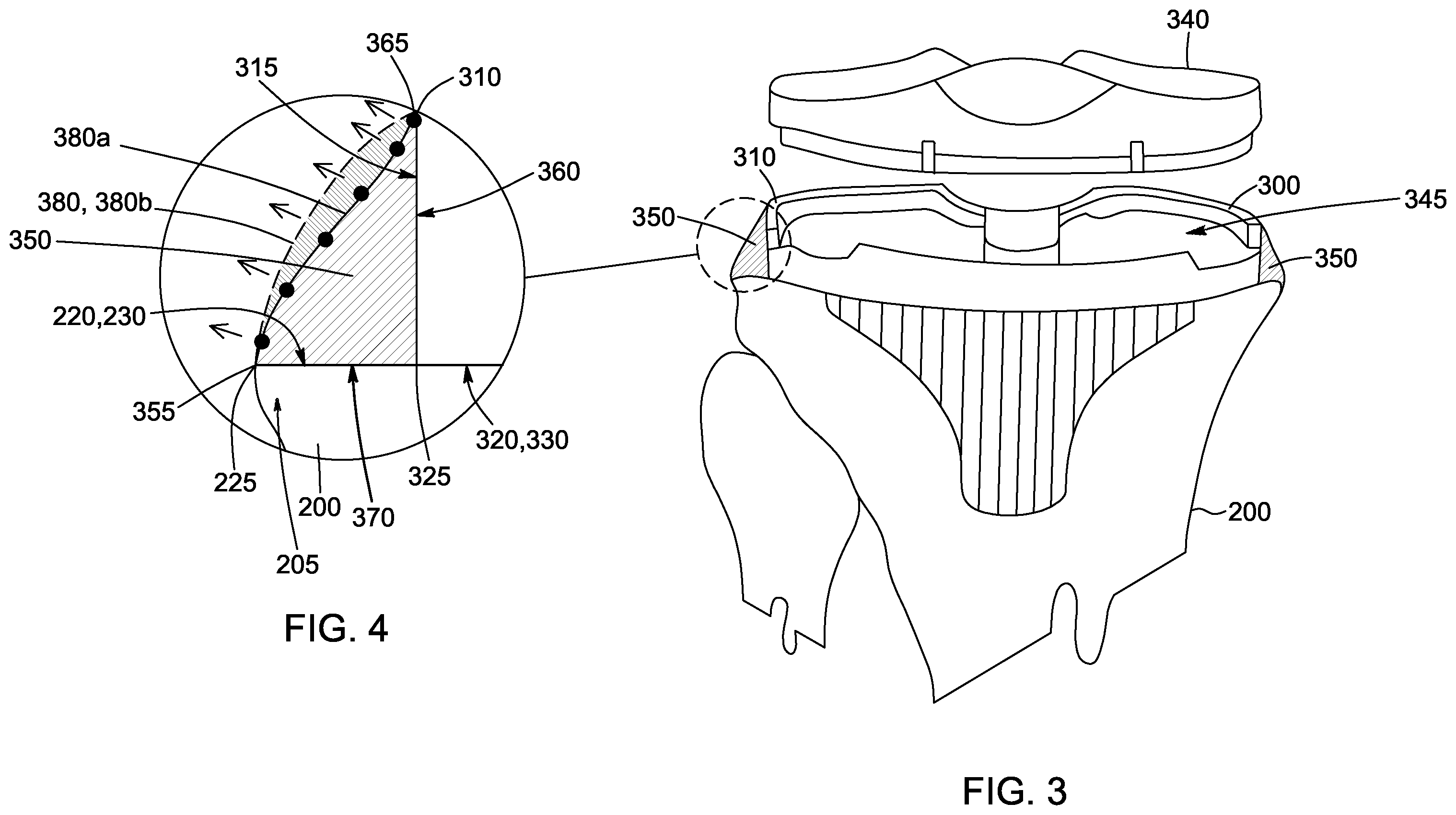 Patent US12472068 Figure 3 – Method for designing a patient-specific implant and patient-specific implant