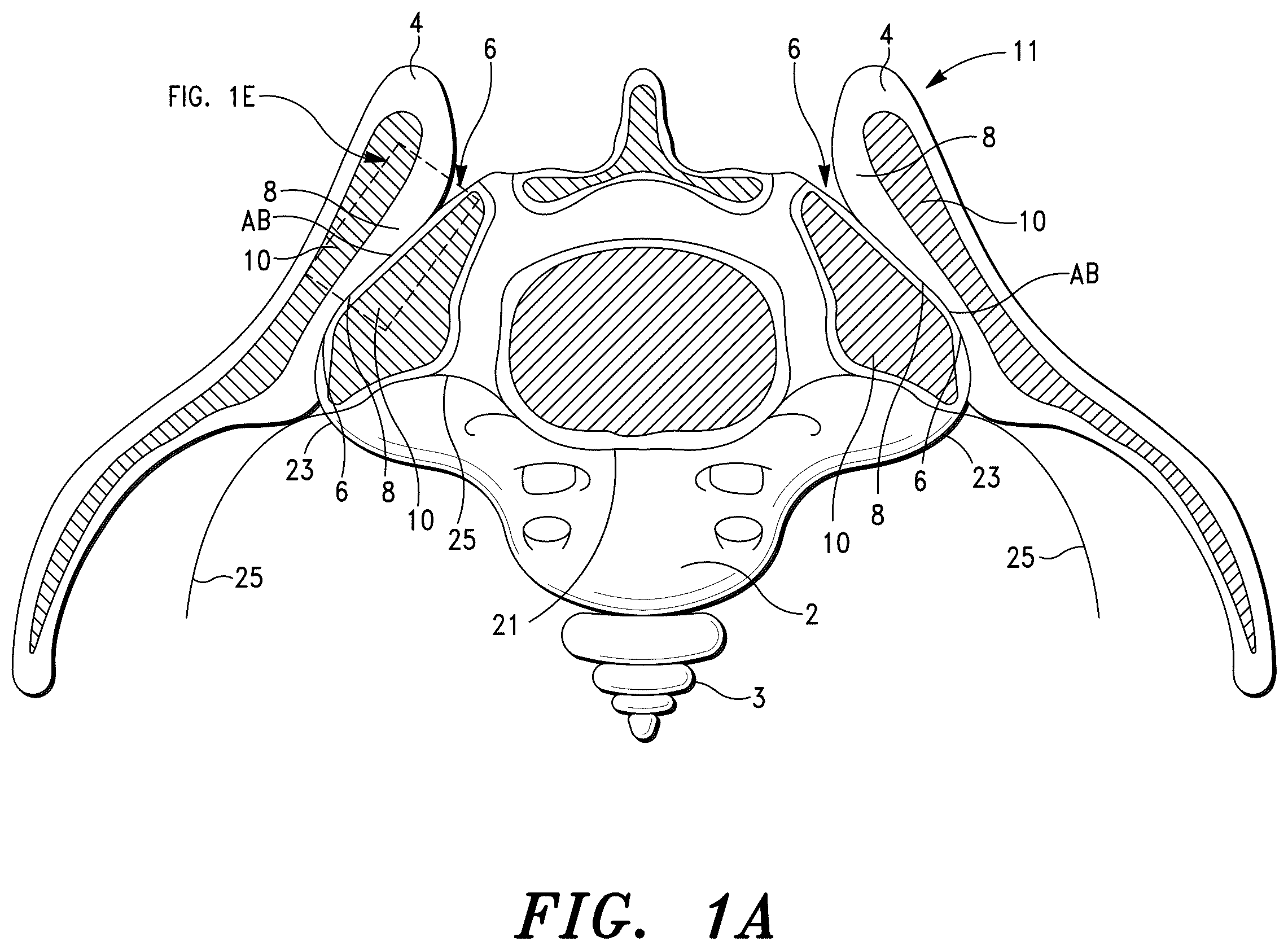 Patent US12472069 Figure 1 – Methods for sacroiliac joint stabilization