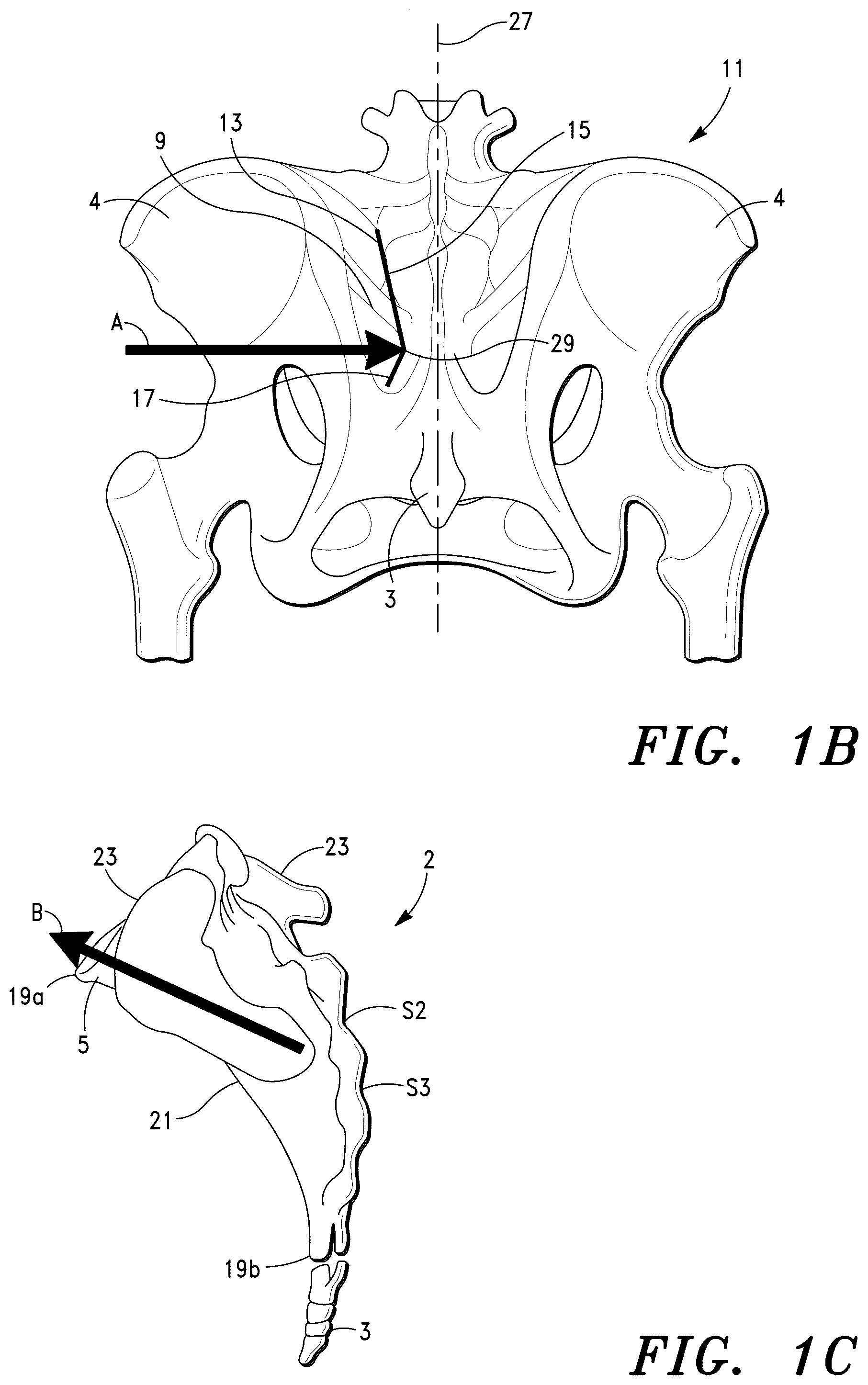 Patent US12472069 Figure 2 – Methods for sacroiliac joint stabilization