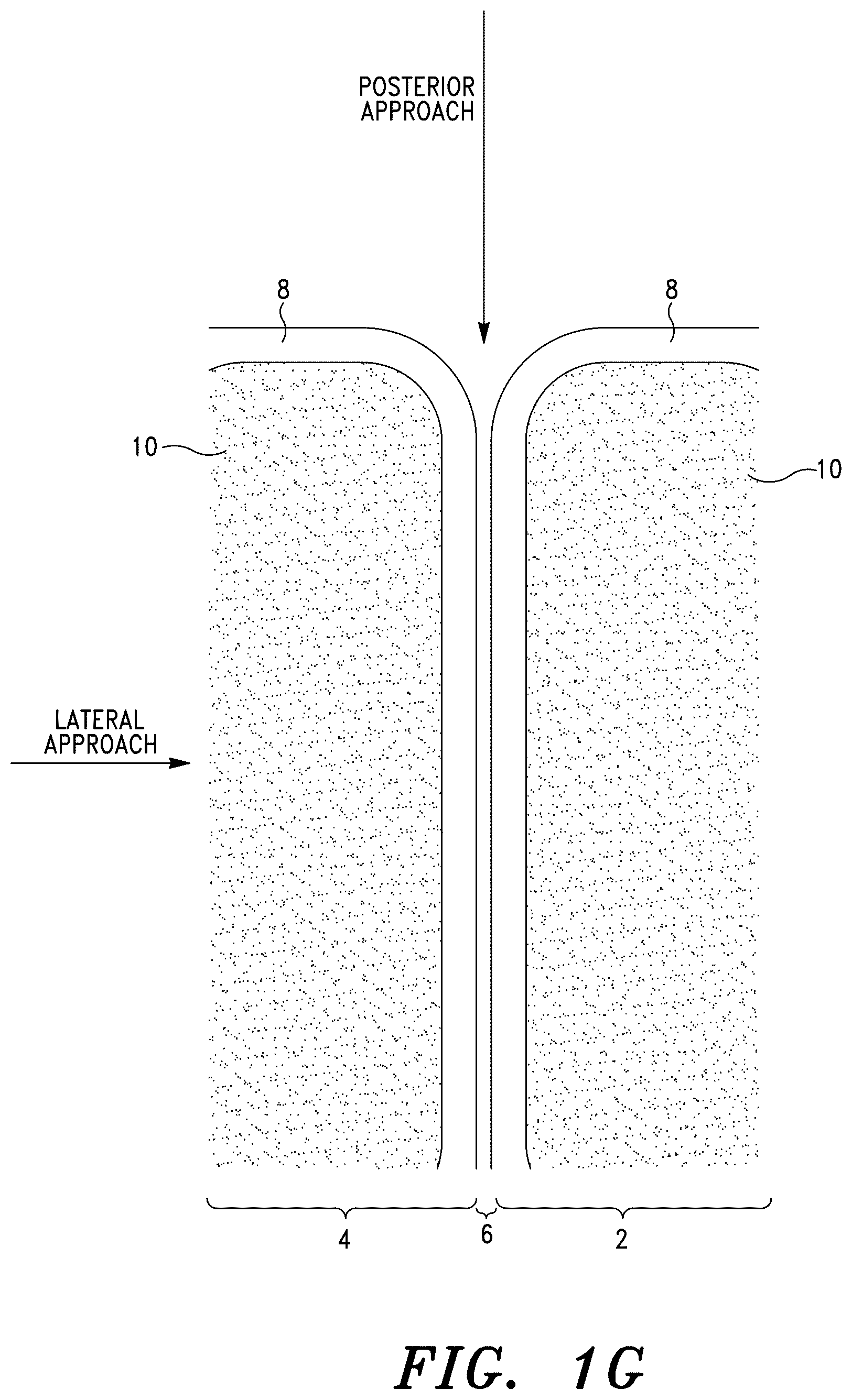 Patent US12472069 Figure 6 – Methods for sacroiliac joint stabilization