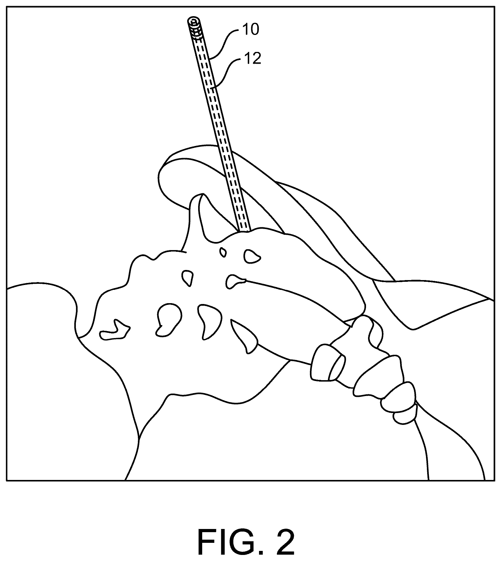Patent US12472070 Figure 2 – Method and apparatus for joint stabilization