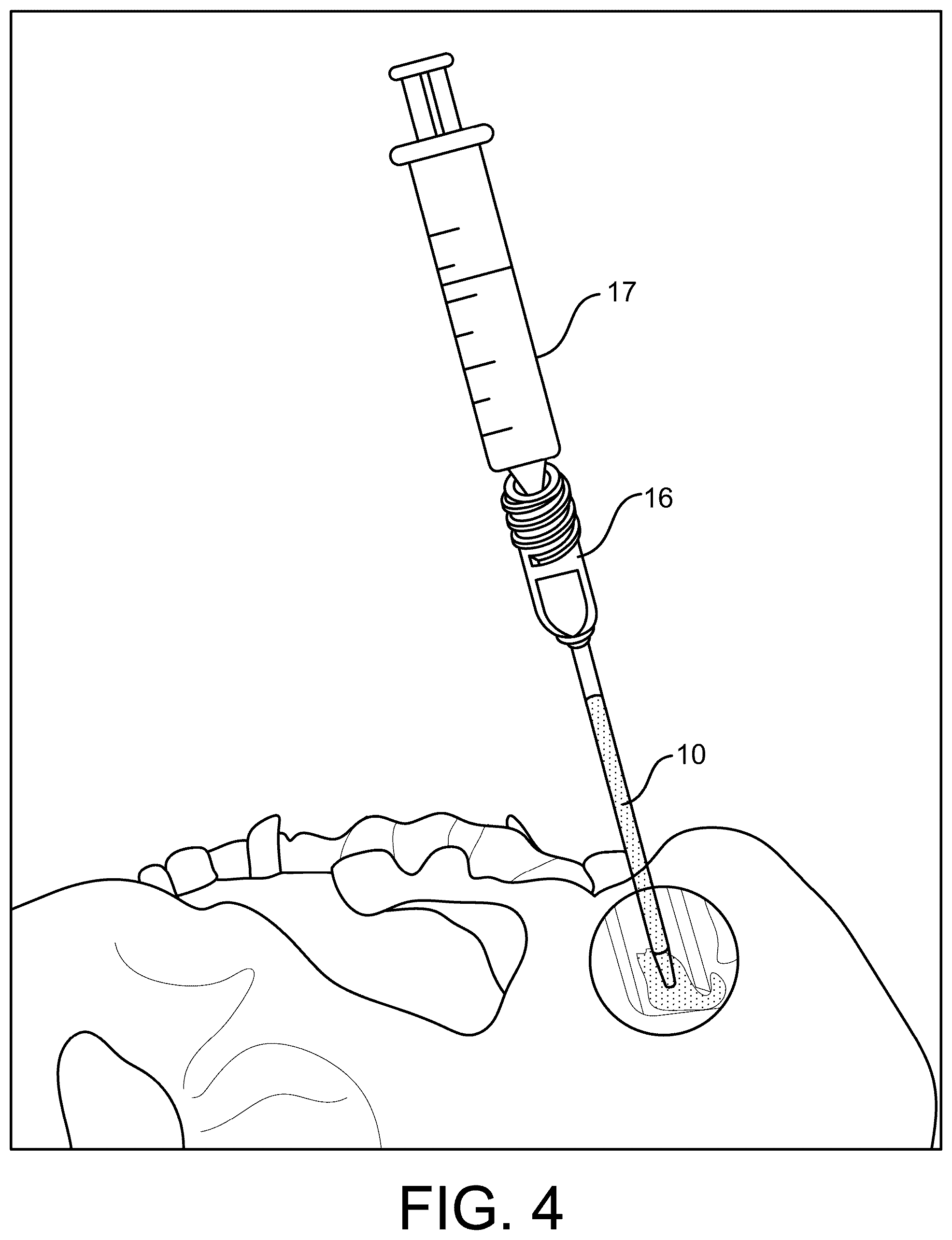 Patent US12472070 Figure 4 – Method and apparatus for joint stabilization