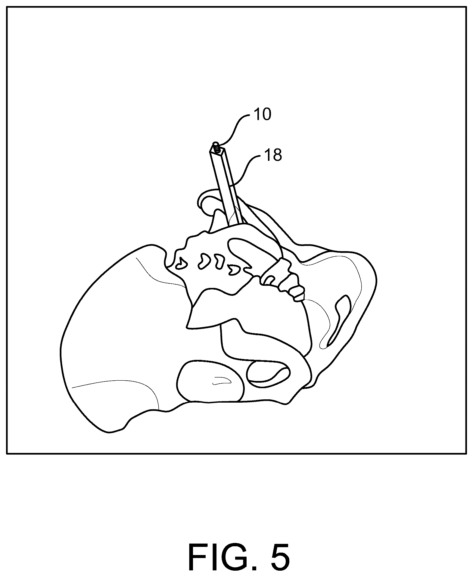 Patent US12472070 Figure 5 – Method and apparatus for joint stabilization