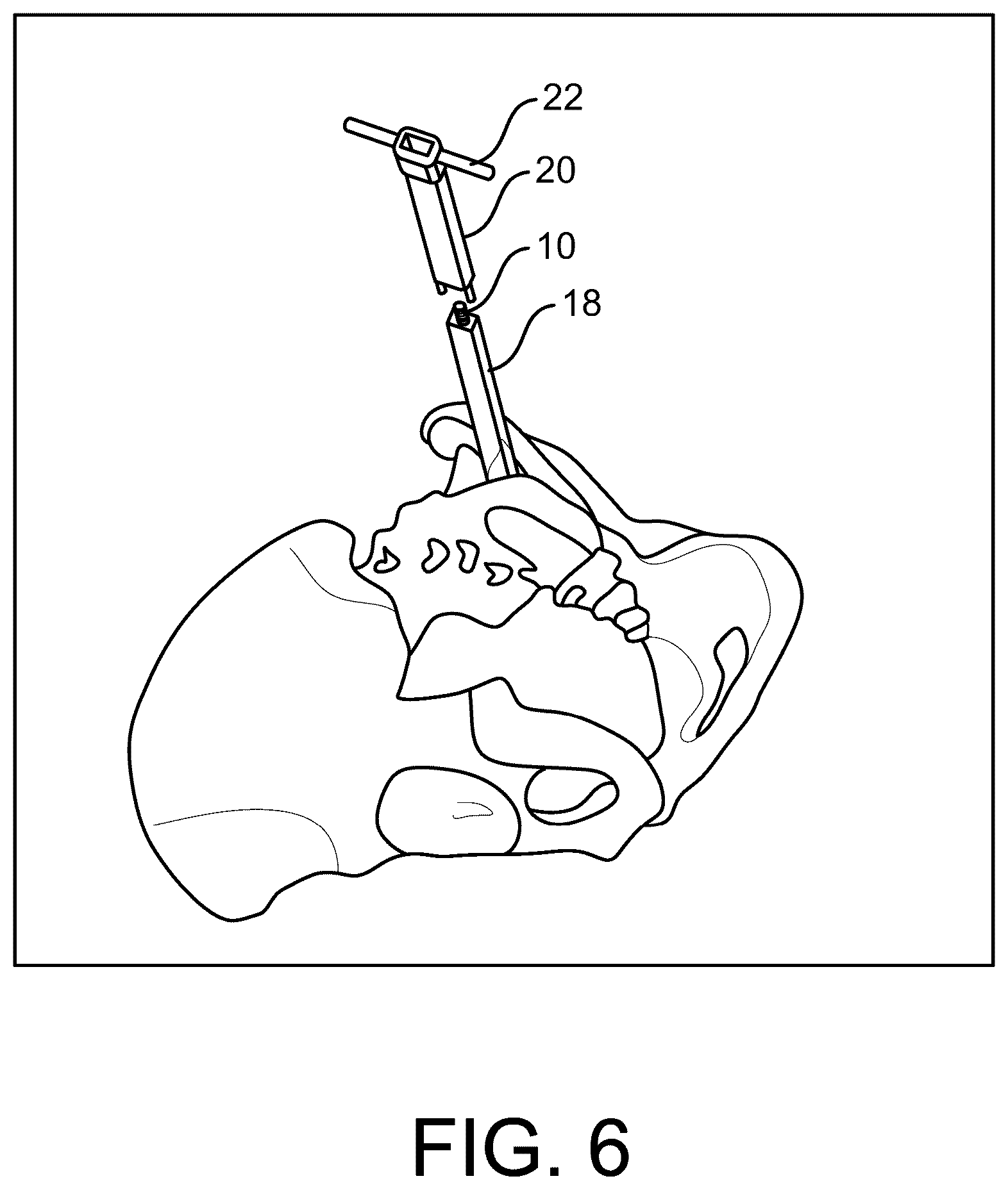 Patent US12472070 Figure 6 – Method and apparatus for joint stabilization