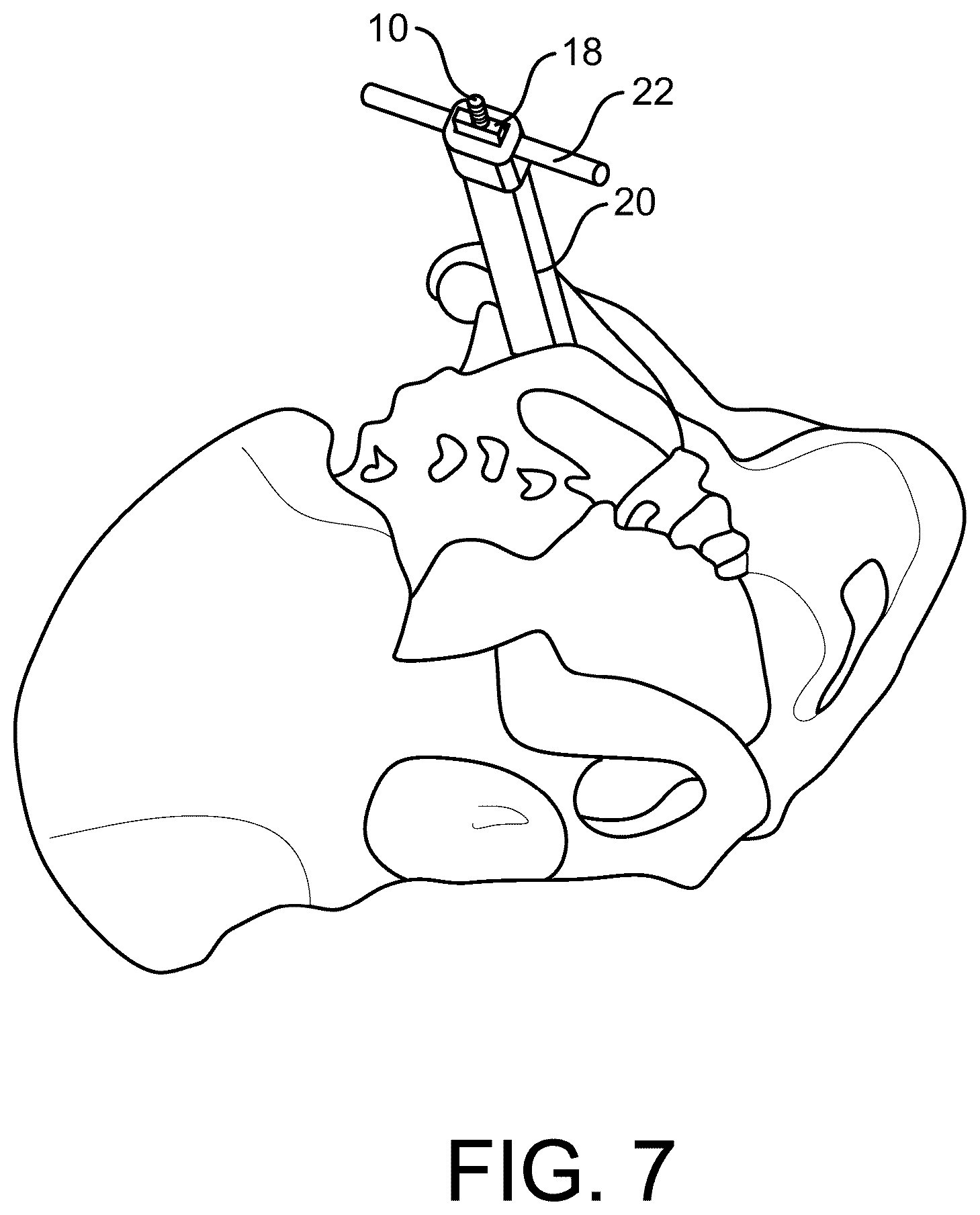 Patent US12472070 Figure 7 – Method and apparatus for joint stabilization