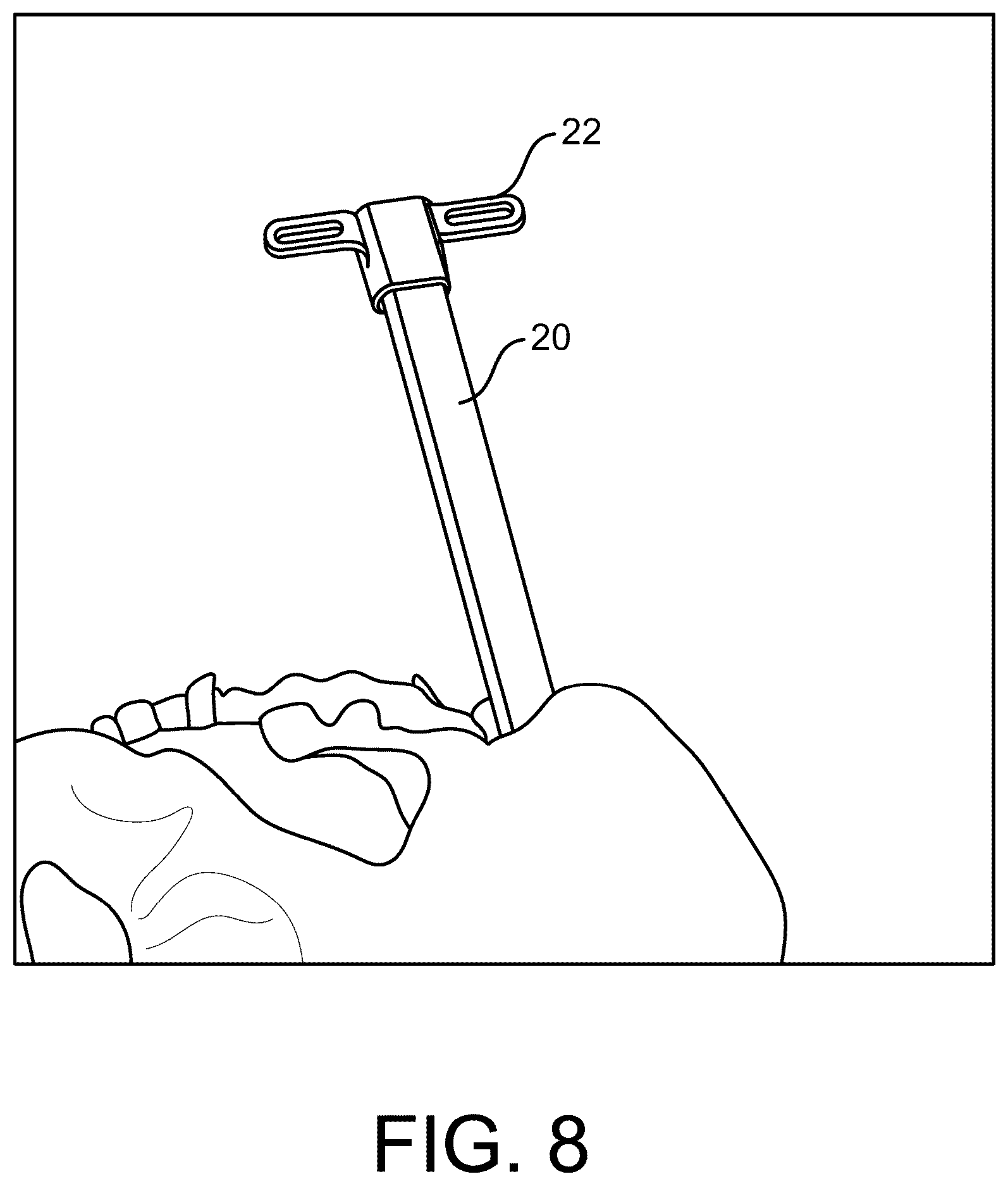 Patent US12472070 Figure 8 – Method and apparatus for joint stabilization