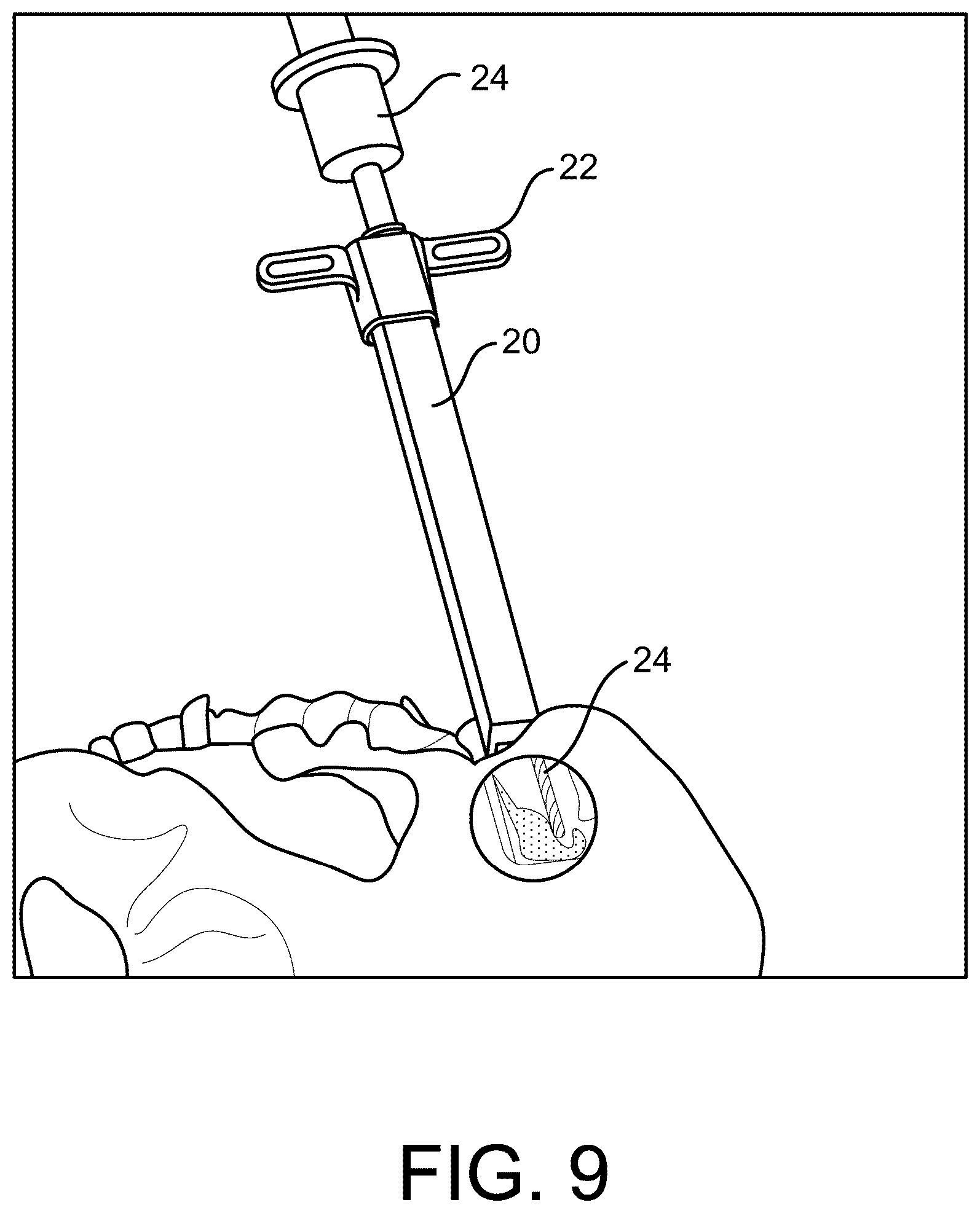 Patent US12472070 Figure 9 – Method and apparatus for joint stabilization