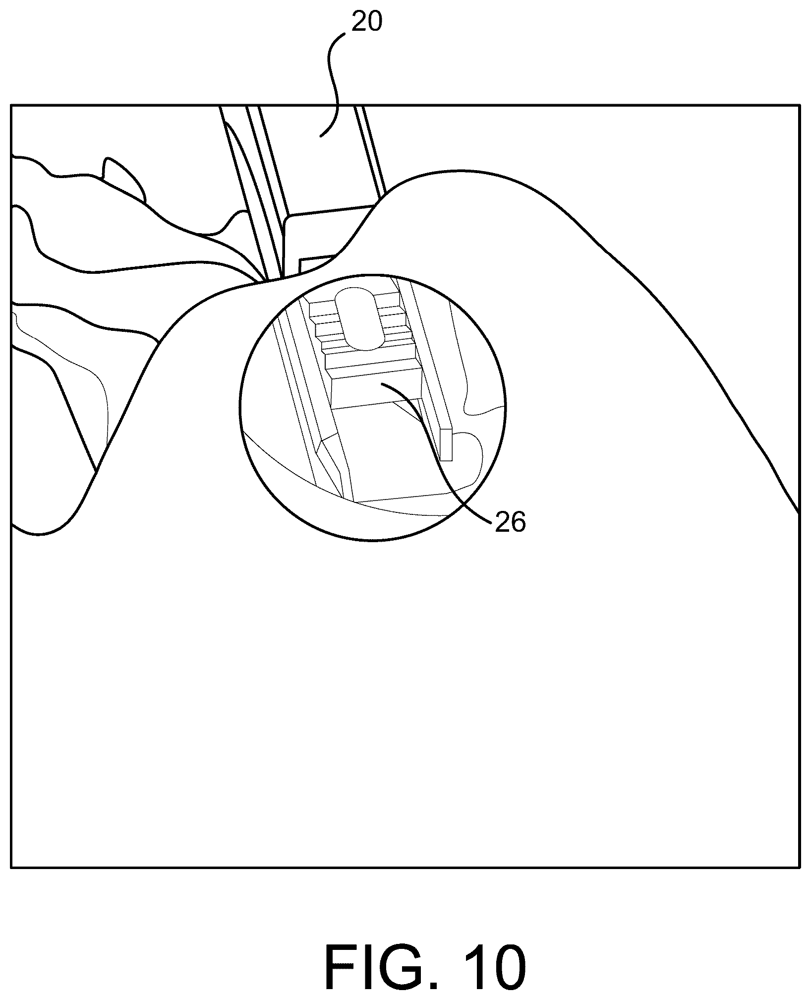 Patent US12472070 Figure 10 – Method and apparatus for joint stabilization