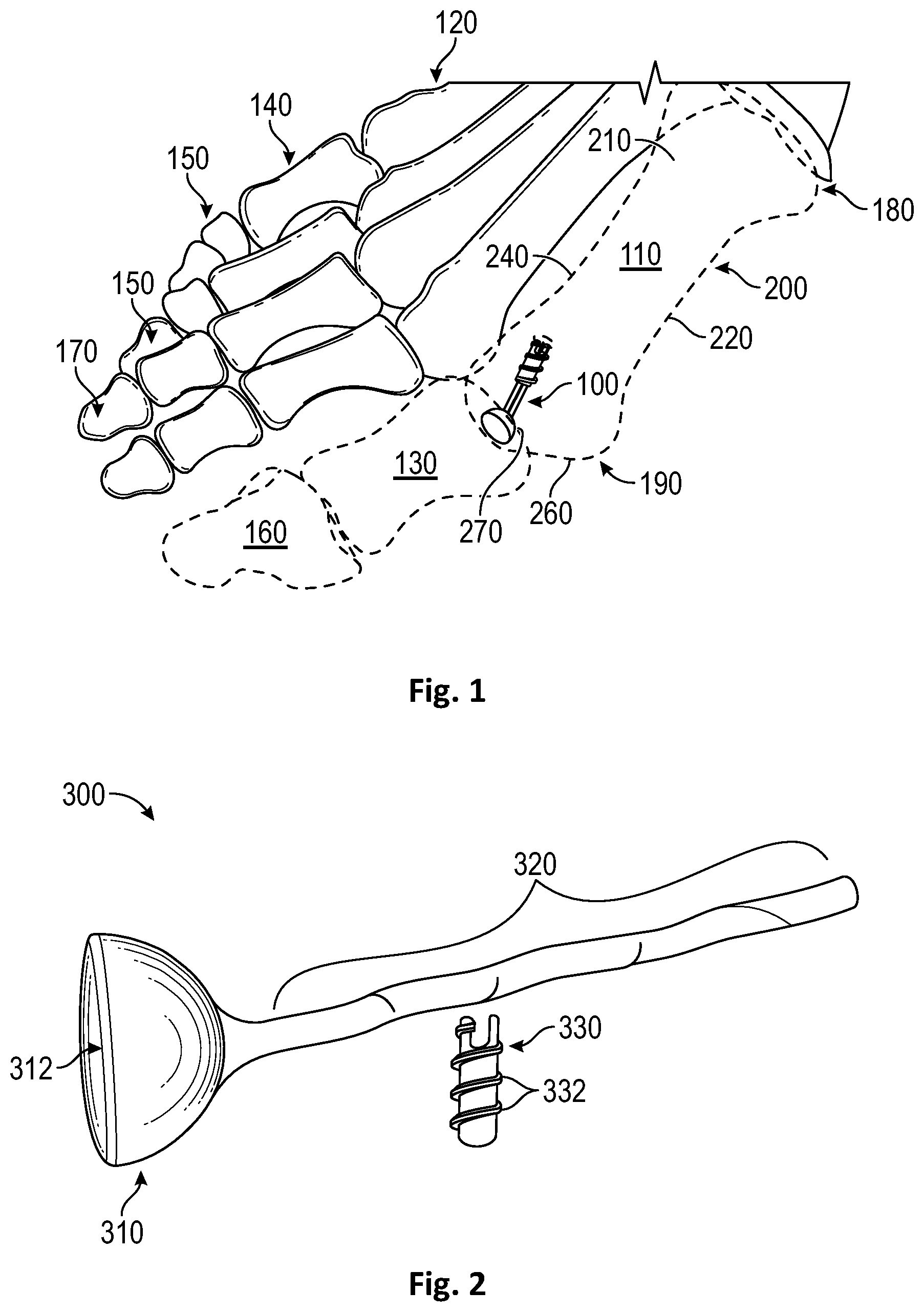 Patent US12472072 Figure 1 – Joint implant apparatus, system, and method
