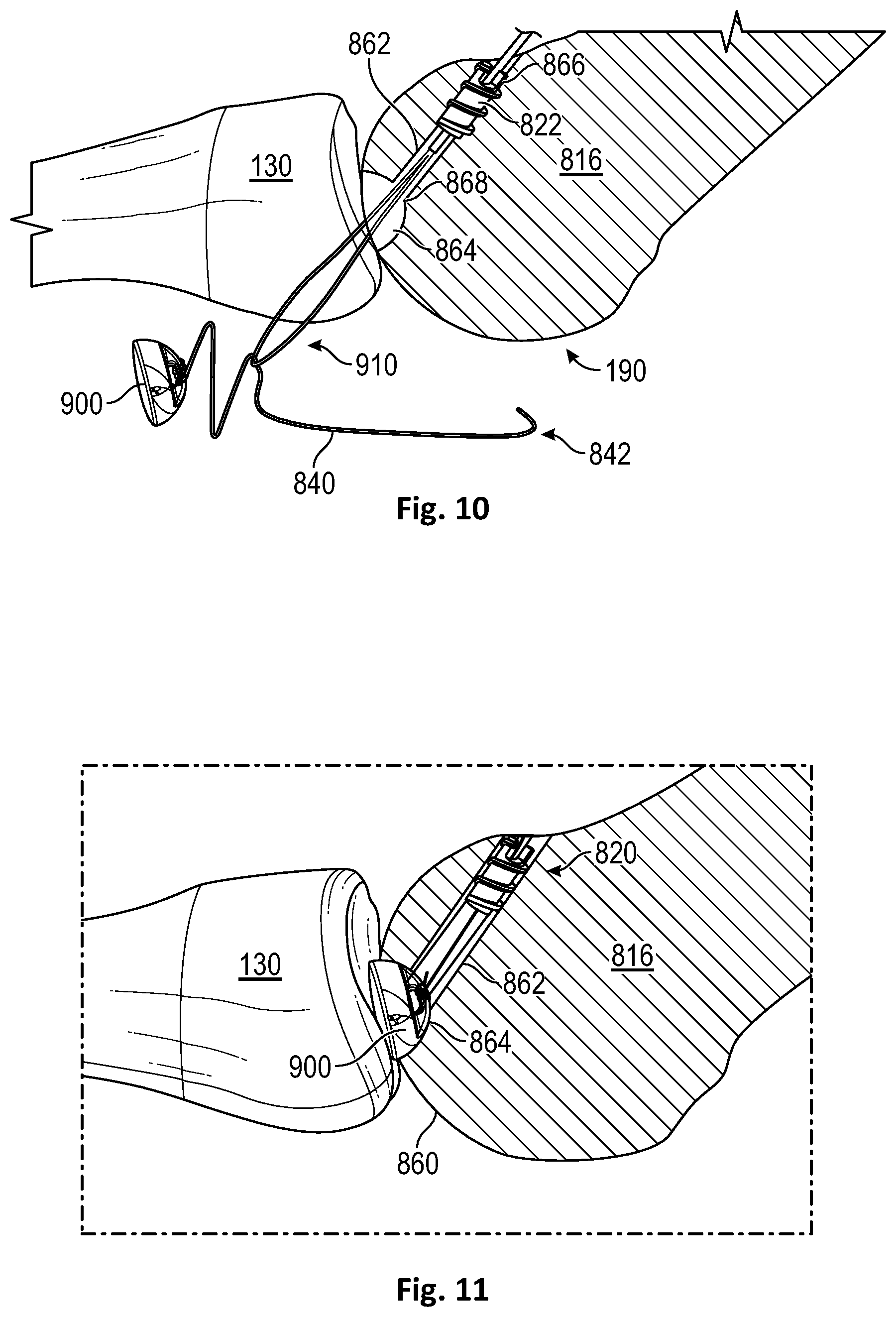 Patent US12472072 Figure 6 – Joint implant apparatus, system, and method