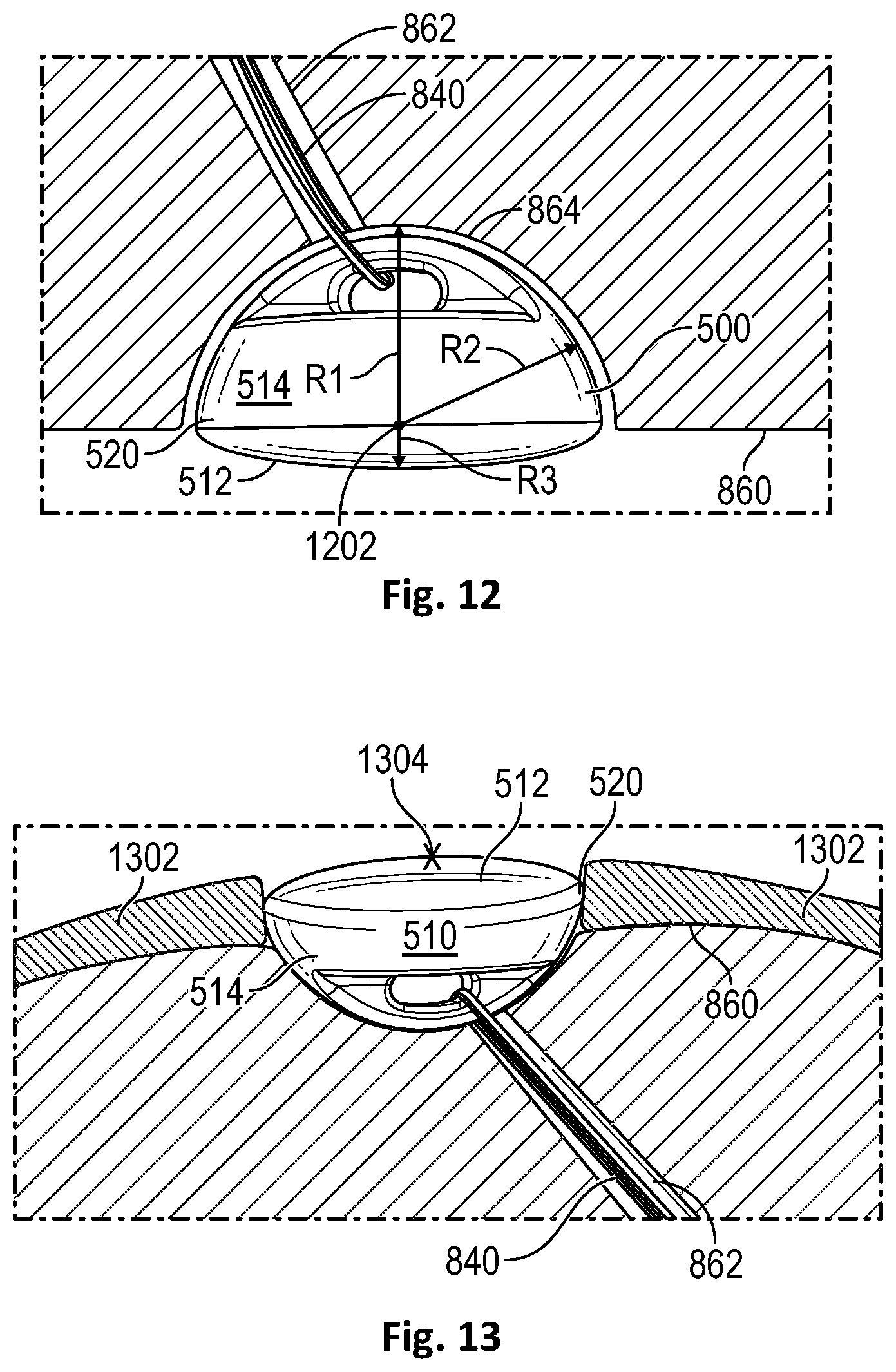 Patent US12472072 Figure 7 – Joint implant apparatus, system, and method