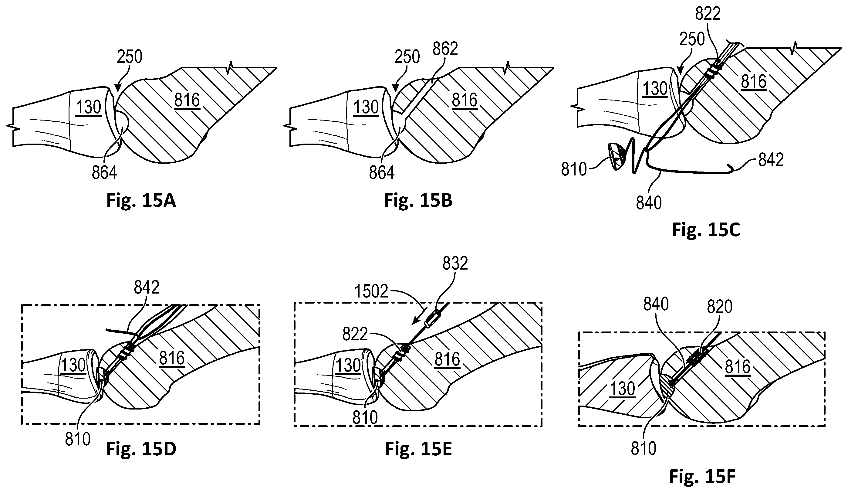 Patent US12472072 Figure 9 – Joint implant apparatus, system, and method