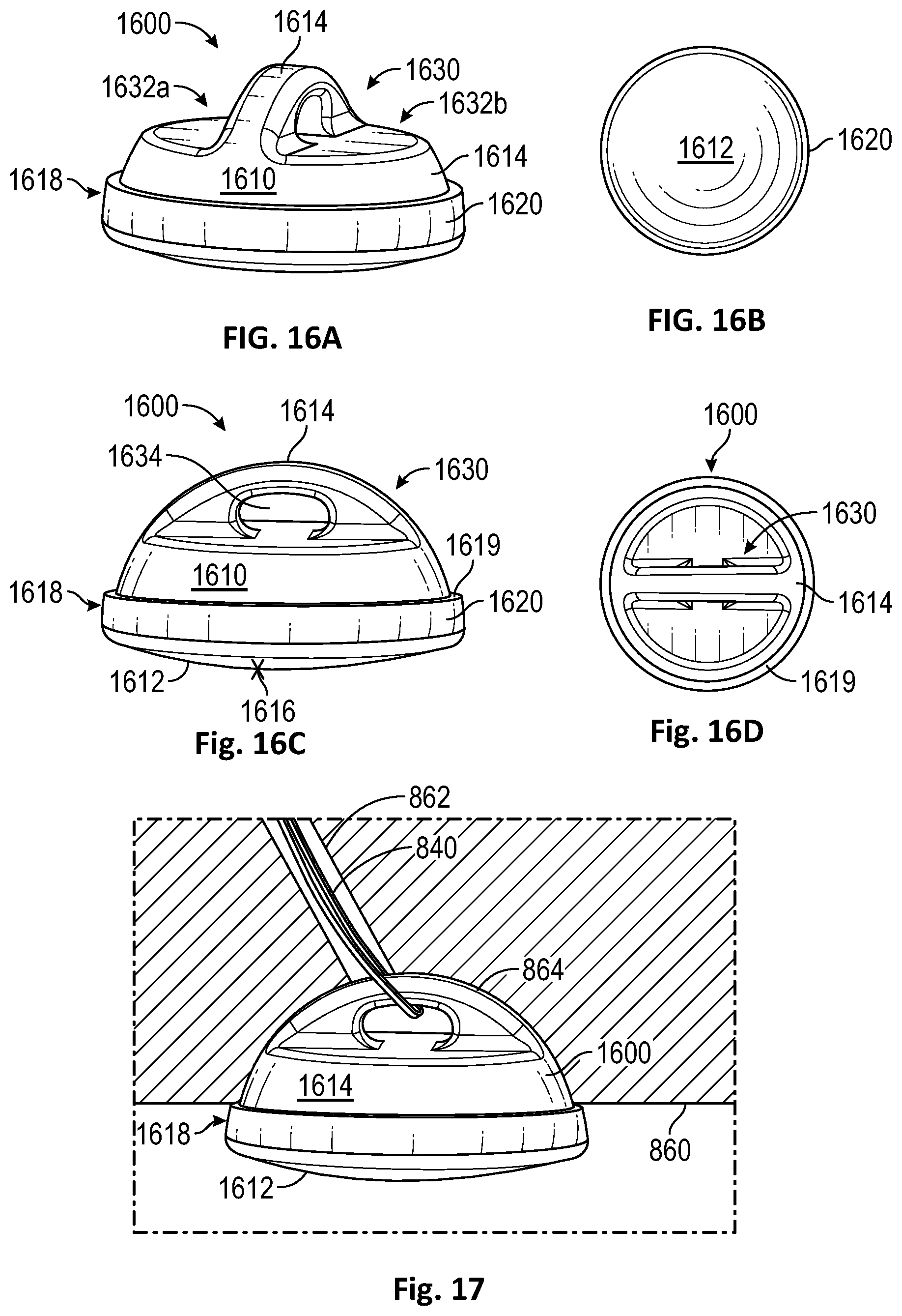 Patent US12472072 Figure 10 – Joint implant apparatus, system, and method