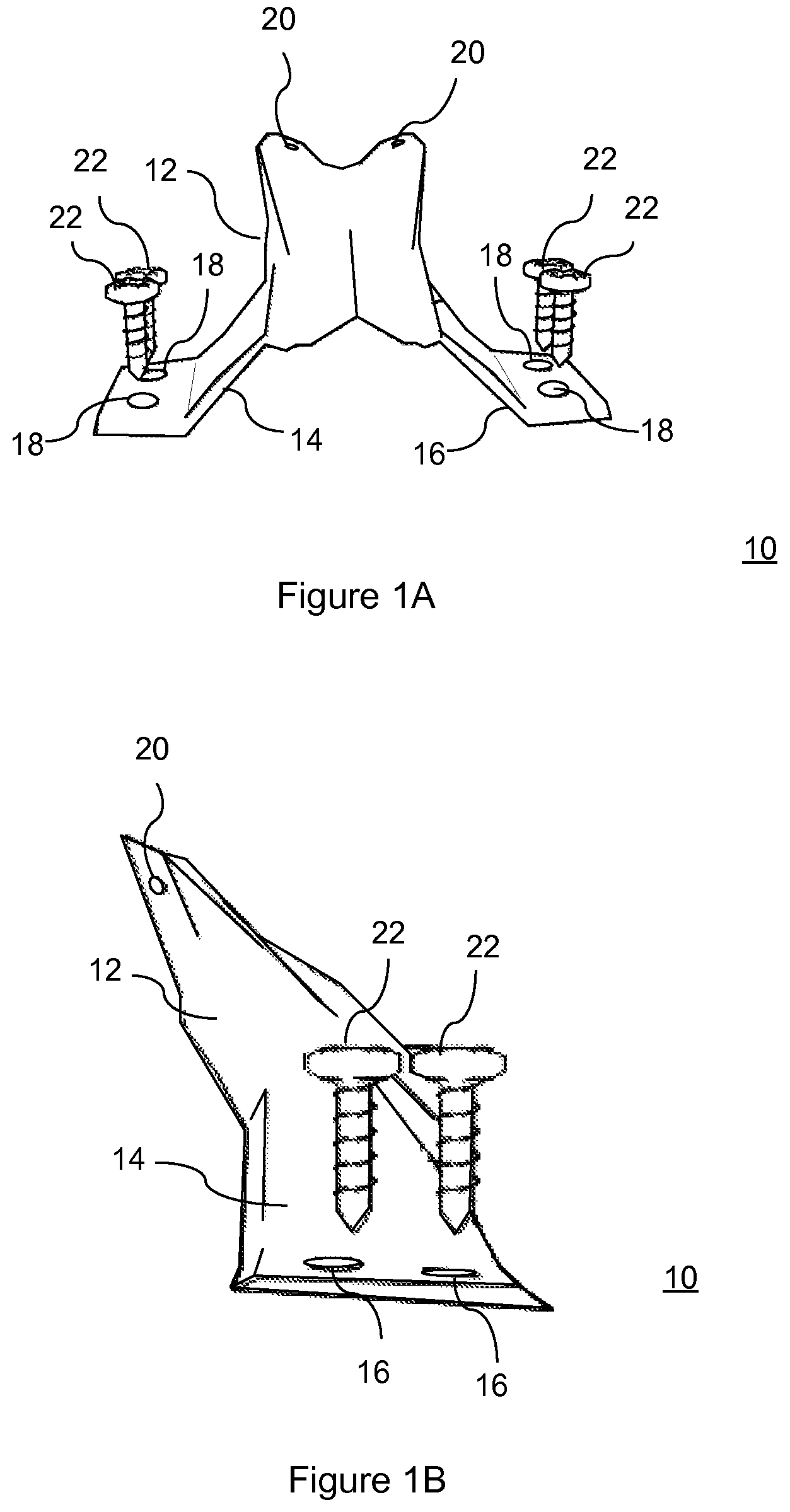 Patent US12472073 Figure 1 – Spinal lamina implant
