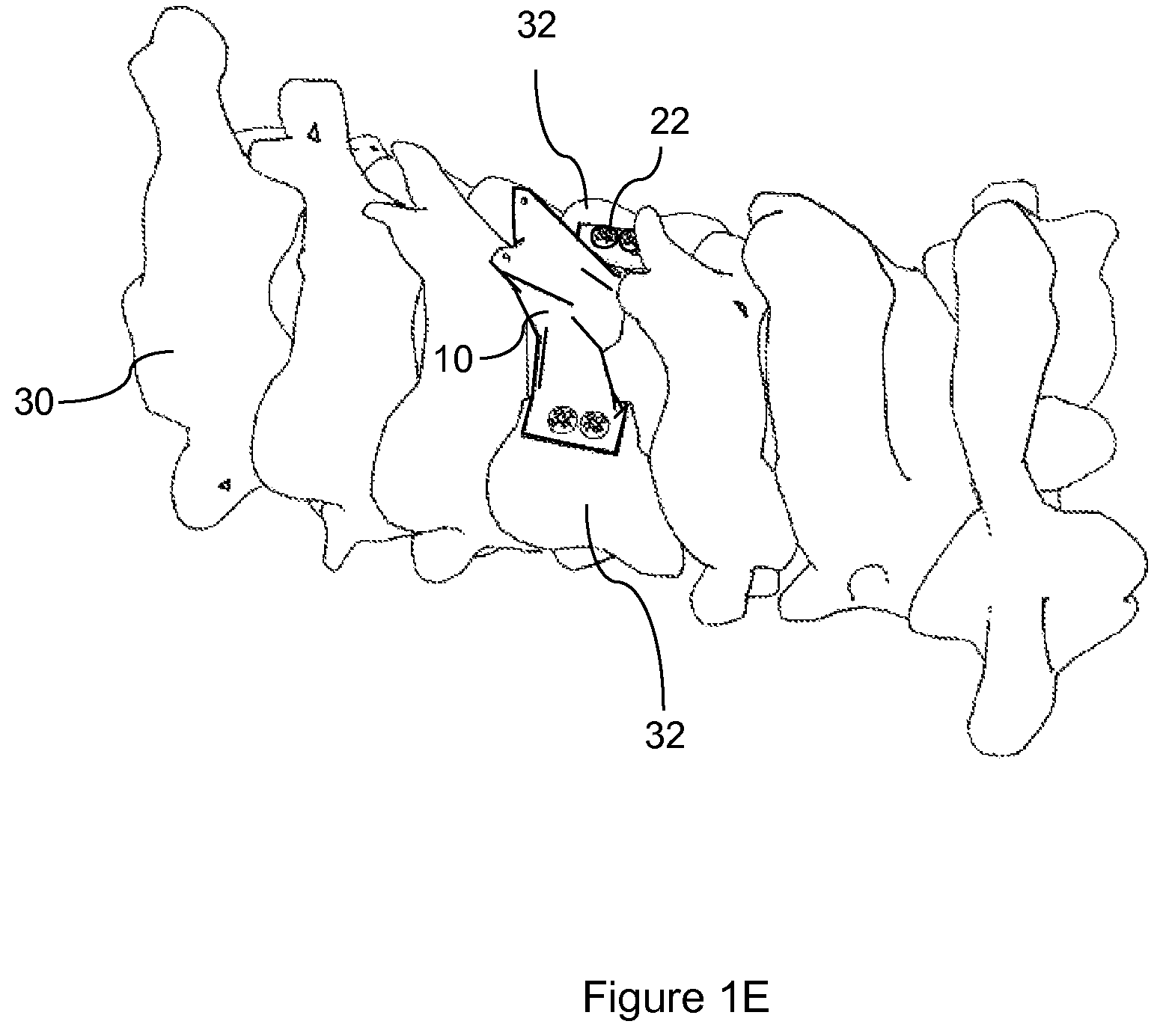Patent US12472073 Figure 3 – Spinal lamina implant