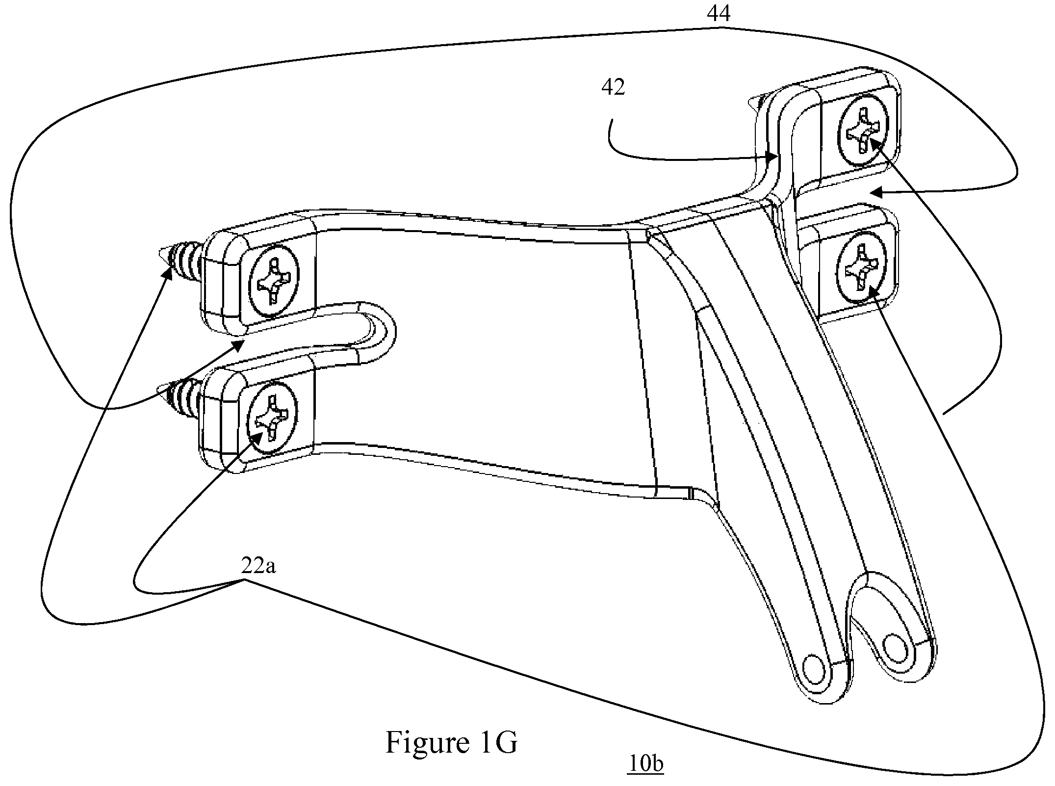 Patent US12472073 Figure 5 – Spinal lamina implant