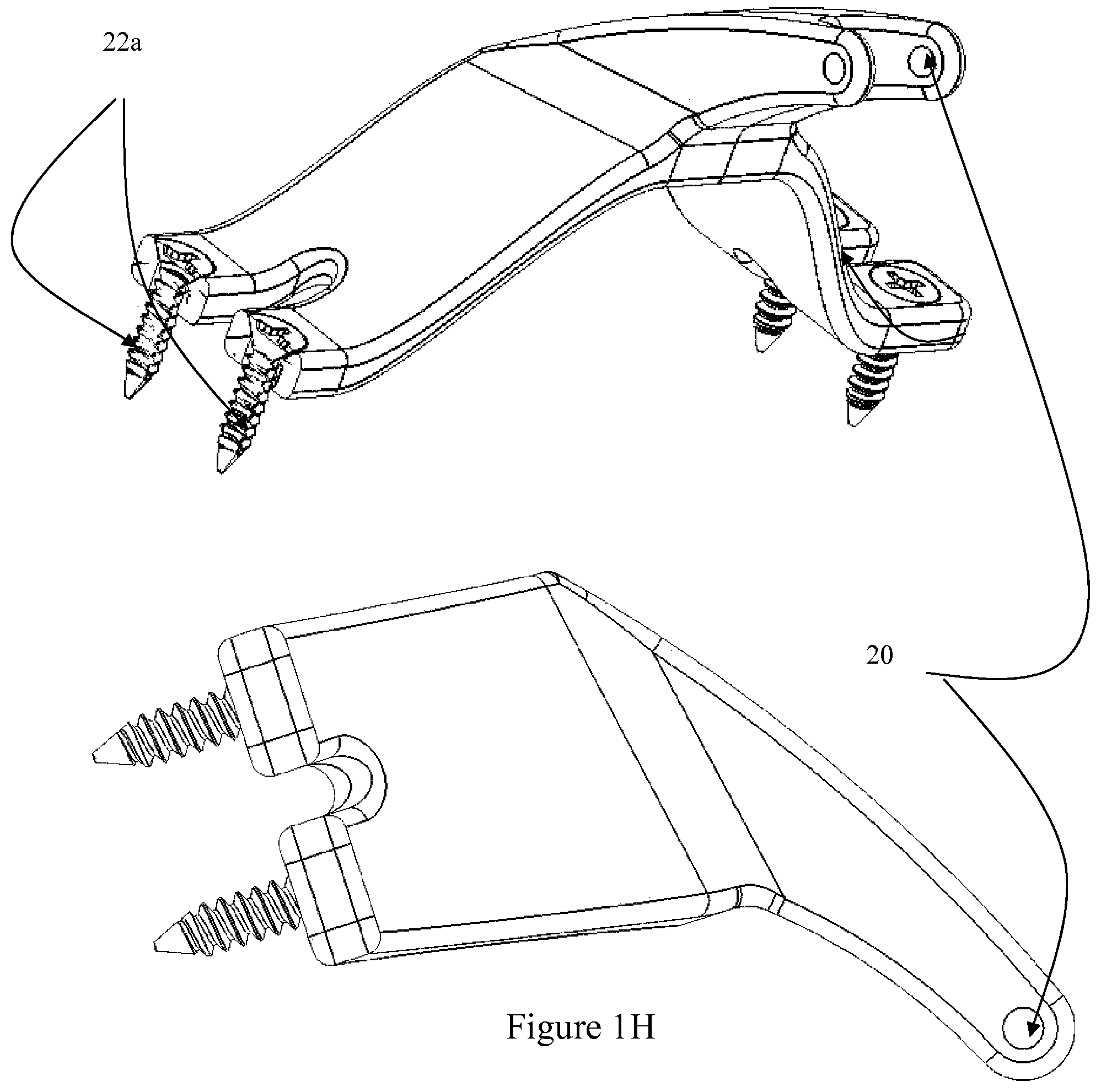 Patent US12472073 Figure 6 – Spinal lamina implant