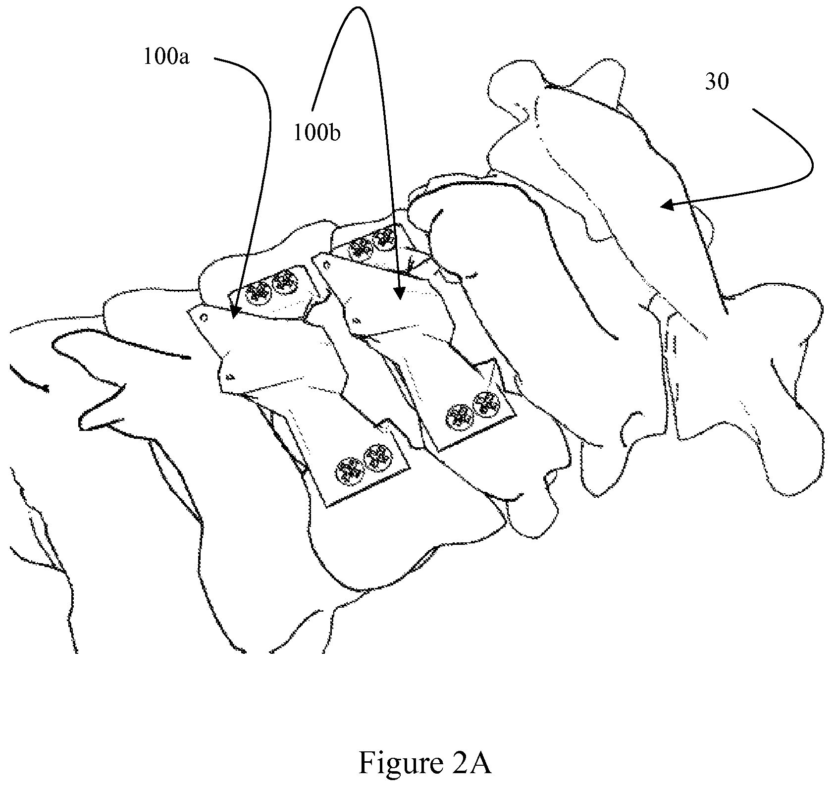 Patent US12472073 Figure 7 – Spinal lamina implant