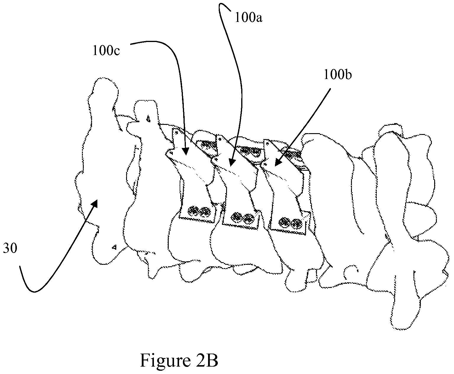 Patent US12472073 Figure 8 – Spinal lamina implant