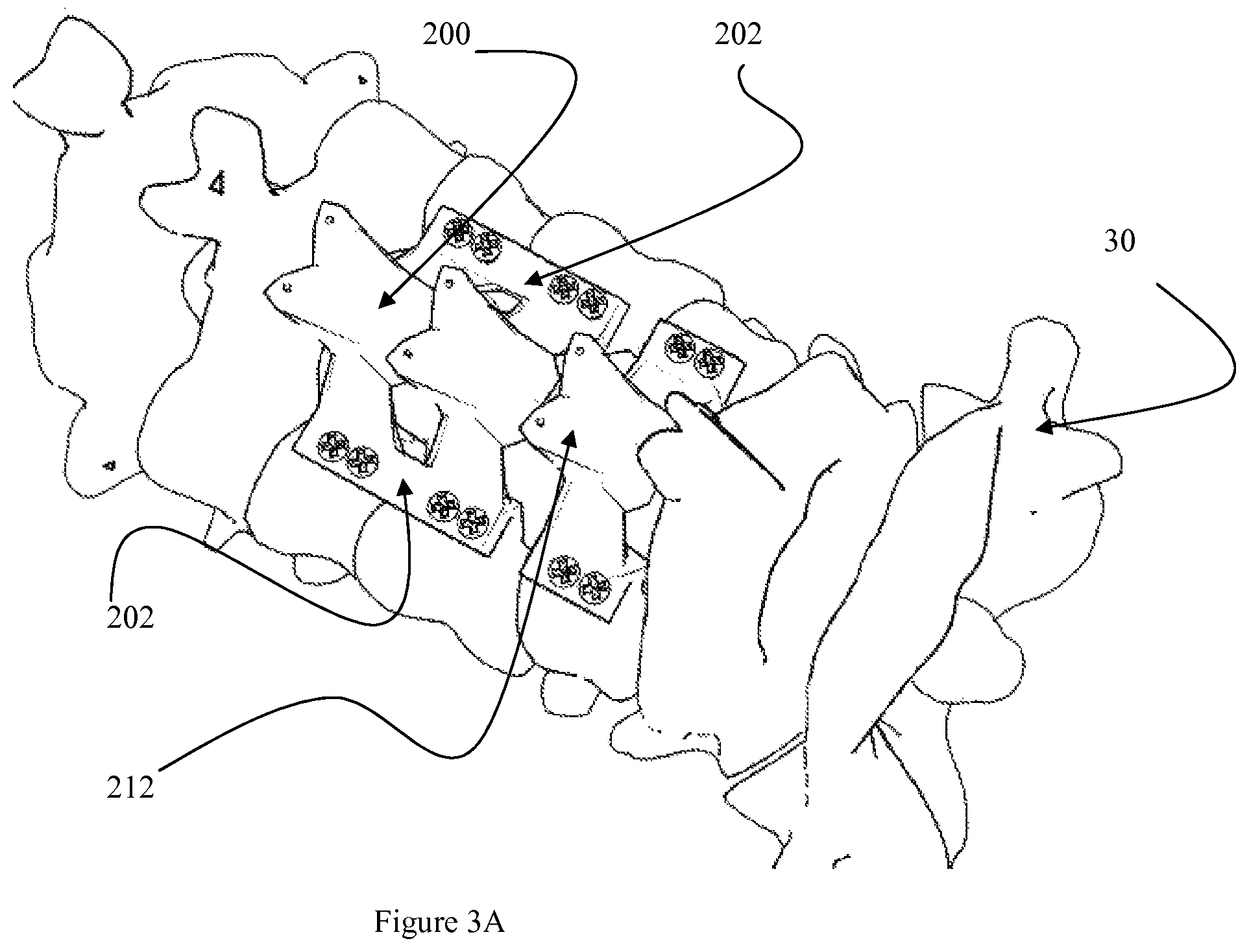 Patent US12472073 Figure 9 – Spinal lamina implant