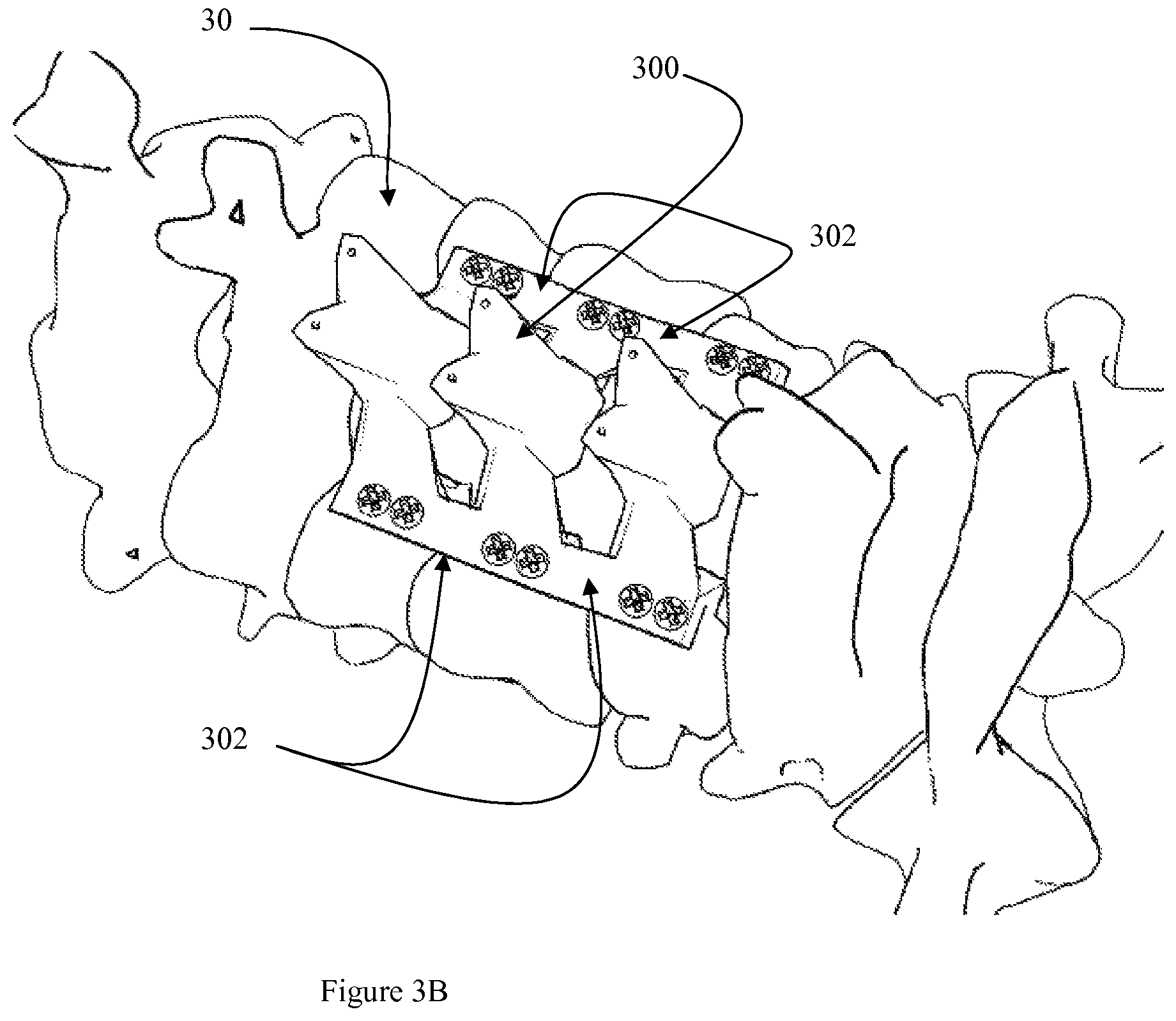 Patent US12472073 Figure 10 – Spinal lamina implant