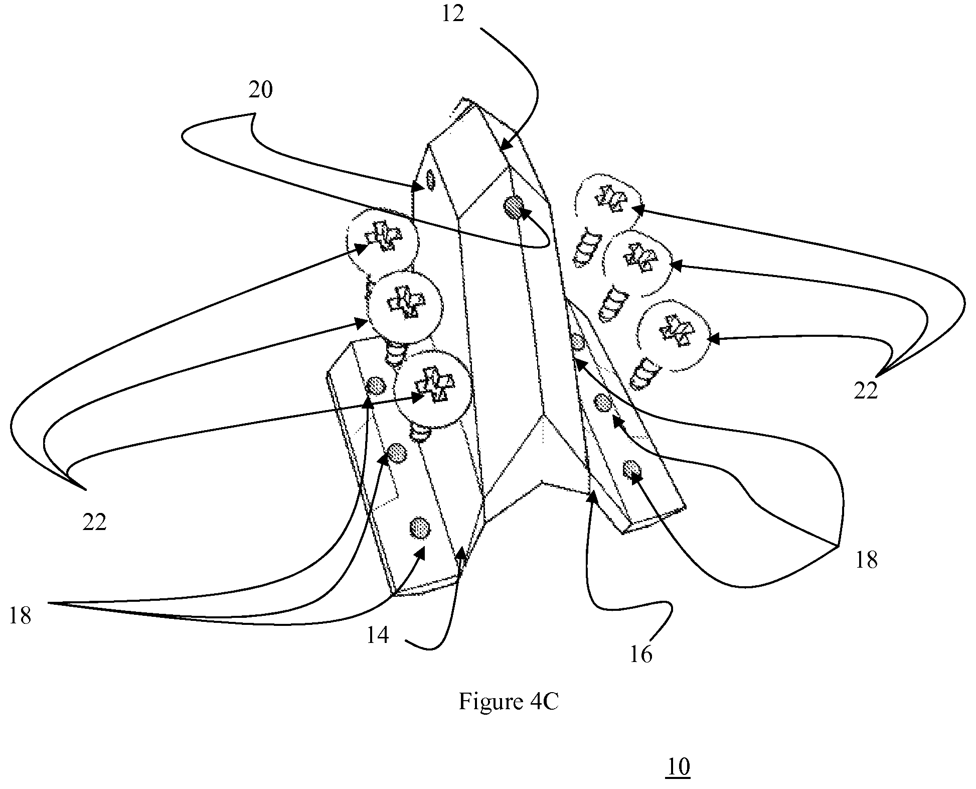 Patent US12472073 Figure 13 – Spinal lamina implant