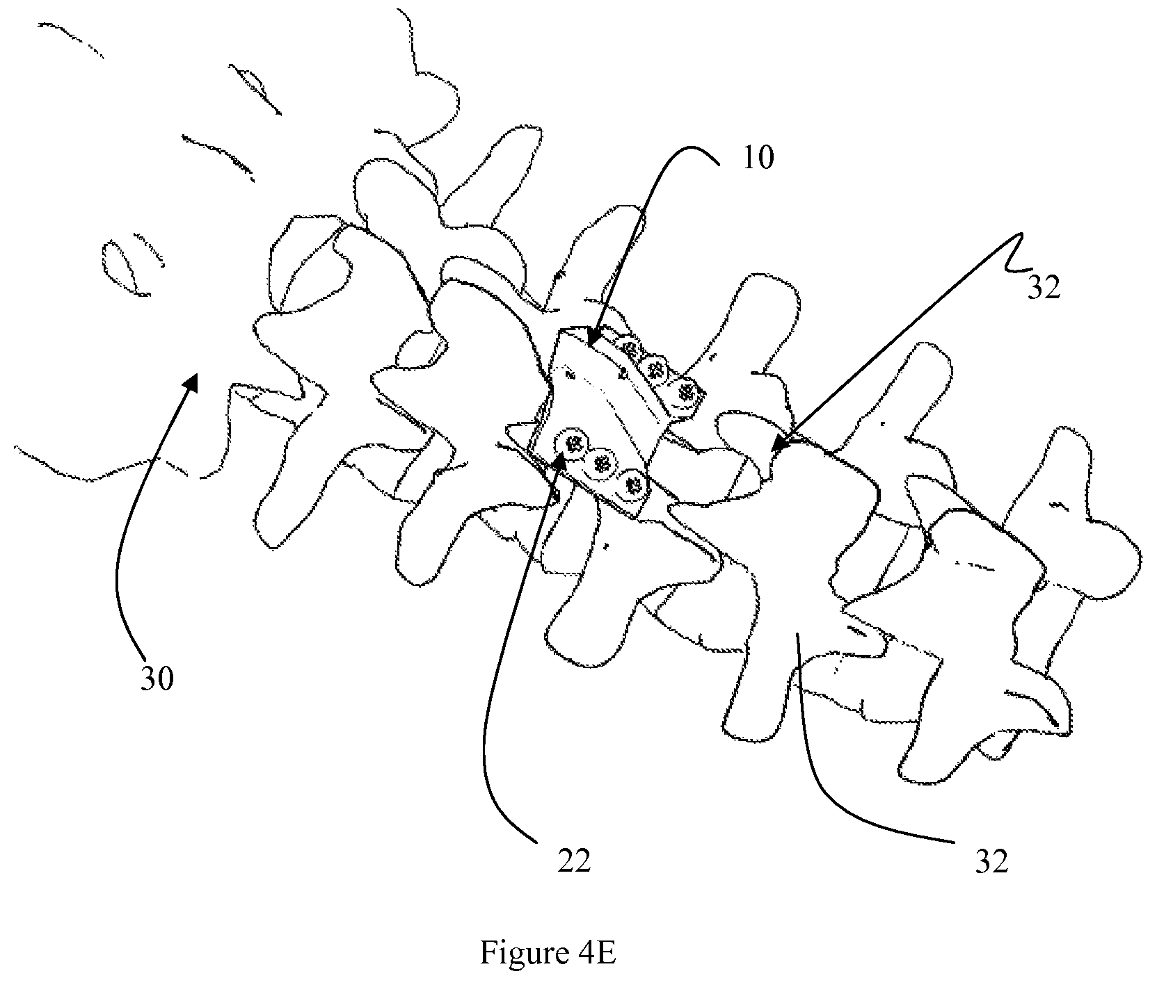 Patent US12472073 Figure 15 – Spinal lamina implant