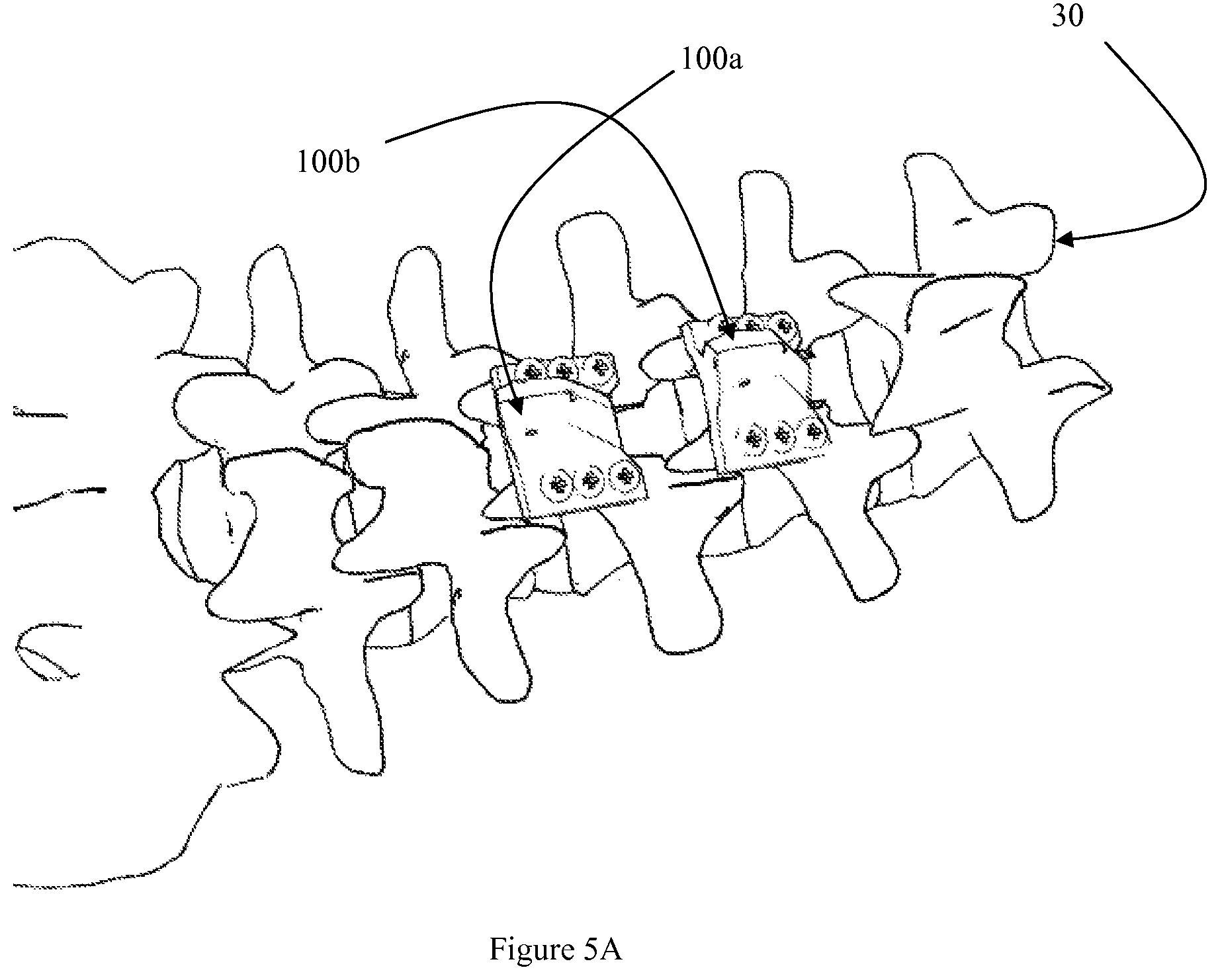 Patent US12472073 Figure 18 – Spinal lamina implant