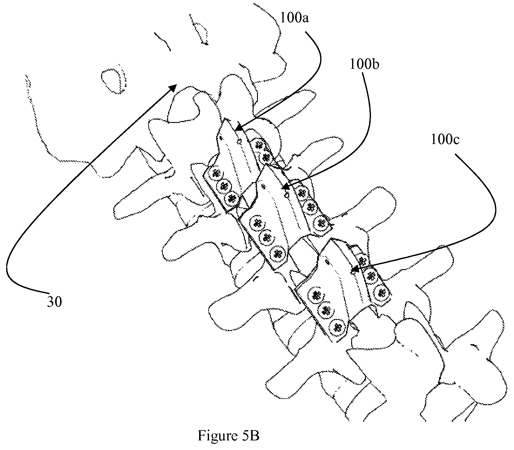 Patent US12472073 Figure 19 – Spinal lamina implant