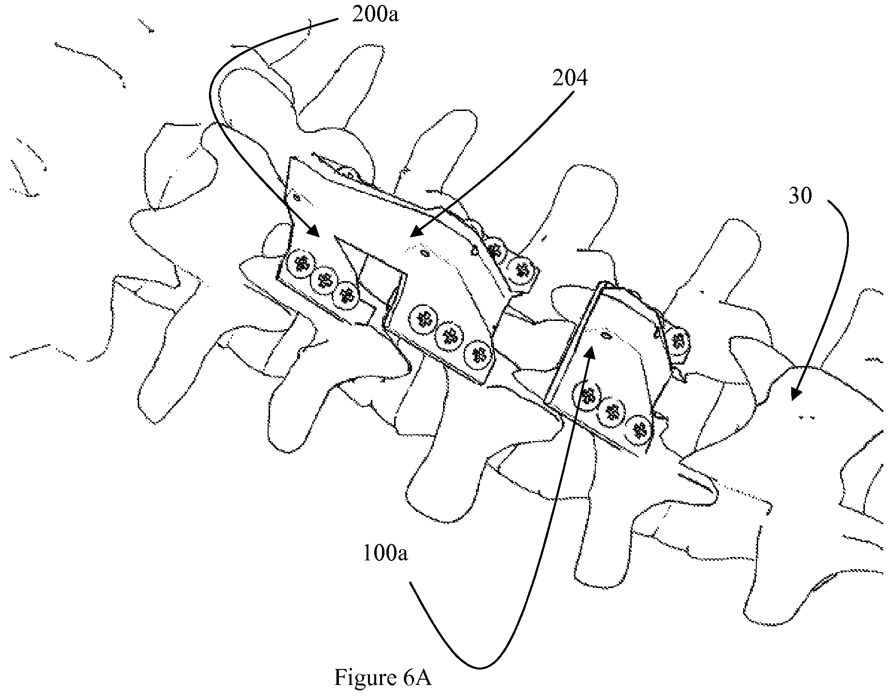 Patent US12472073 Figure 20 – Spinal lamina implant