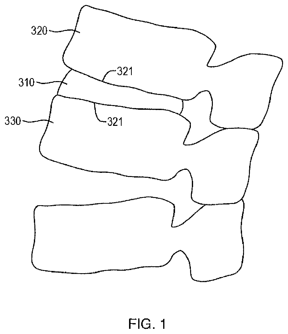 Patent US12472074 — Expandable spinal implant apparatus and method of use — Figure 1