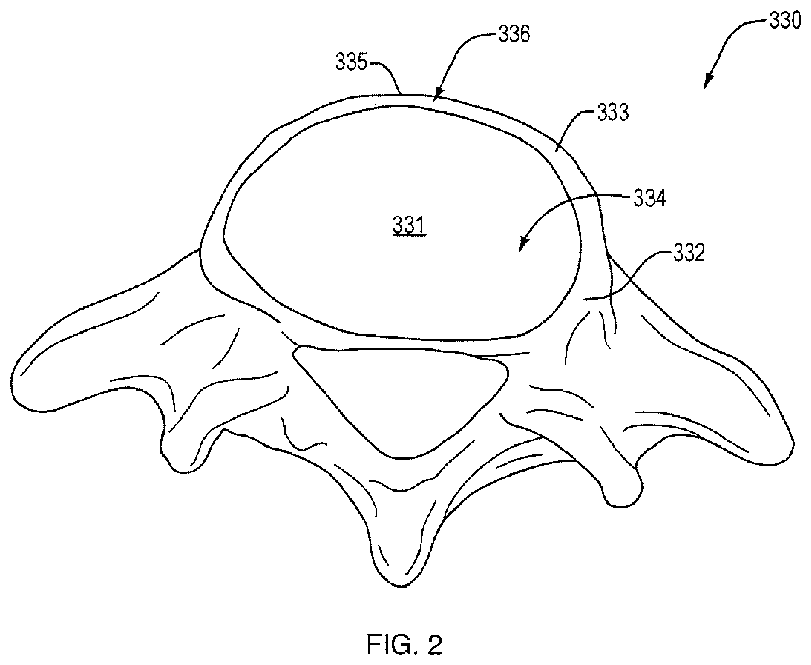 Patent US12472074 Figure 2 – Expandable spinal implant apparatus and method of use