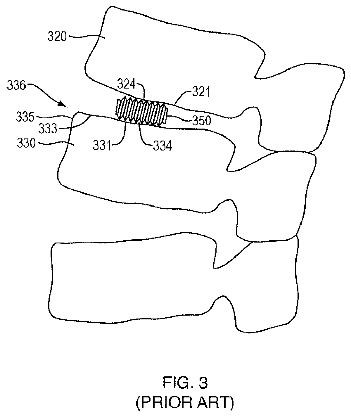 Patent US12472074 Figure 3 – Expandable spinal implant apparatus and method of use