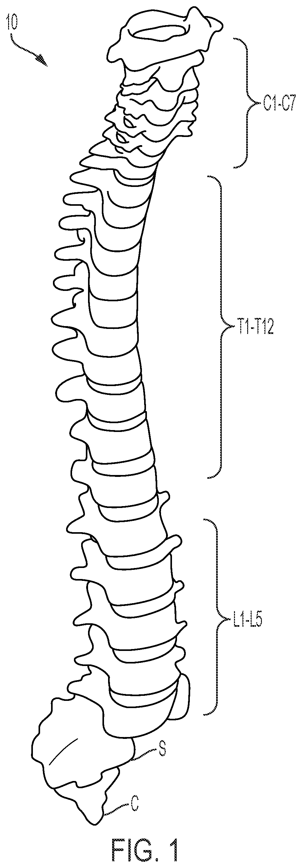 Patent US12472075 — Expandable intervertebral fusion implant — Figure 1