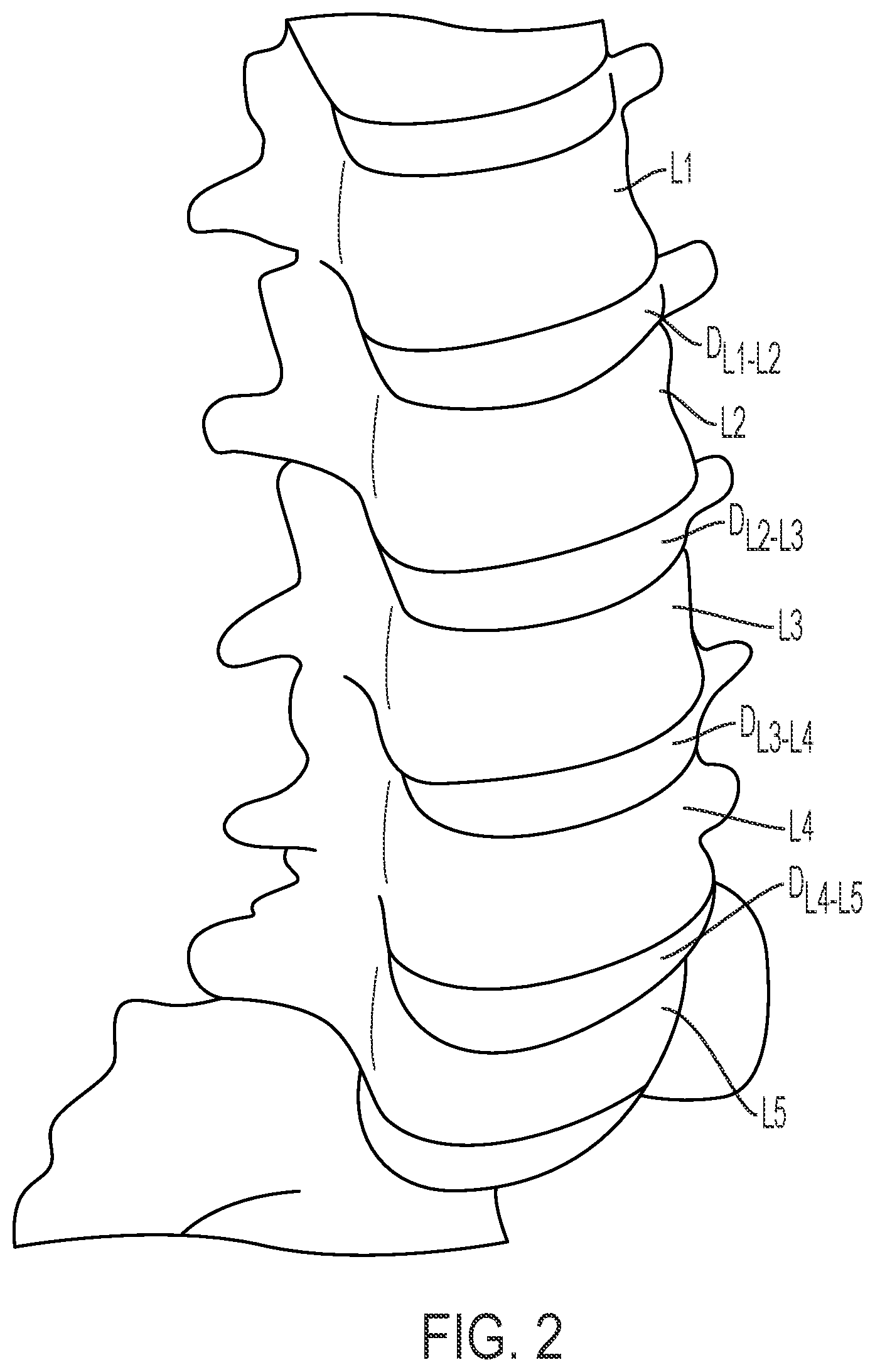 Patent US12472075 Figure 2 – Expandable intervertebral fusion implant