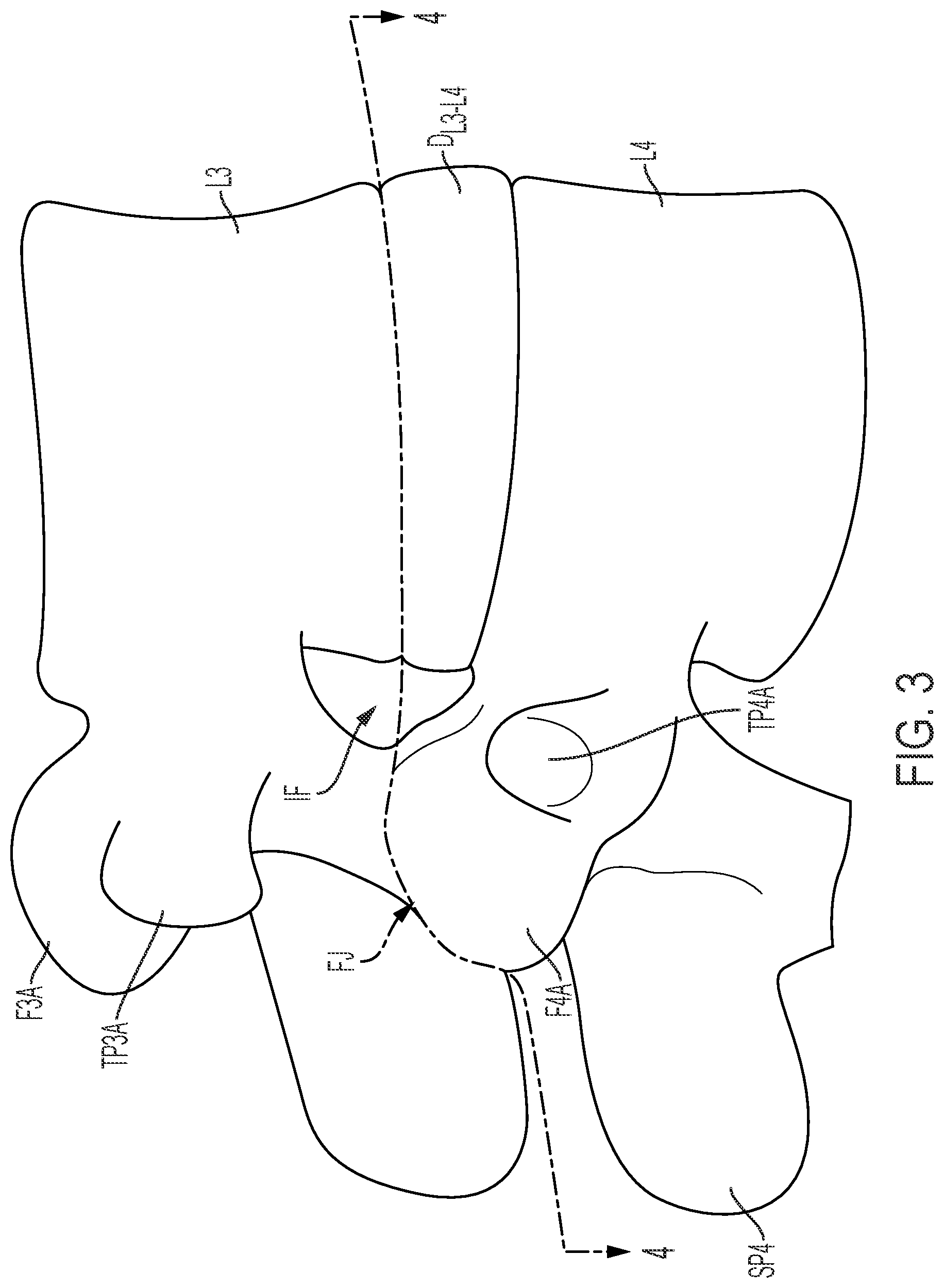 Patent US12472075 Figure 3 – Expandable intervertebral fusion implant