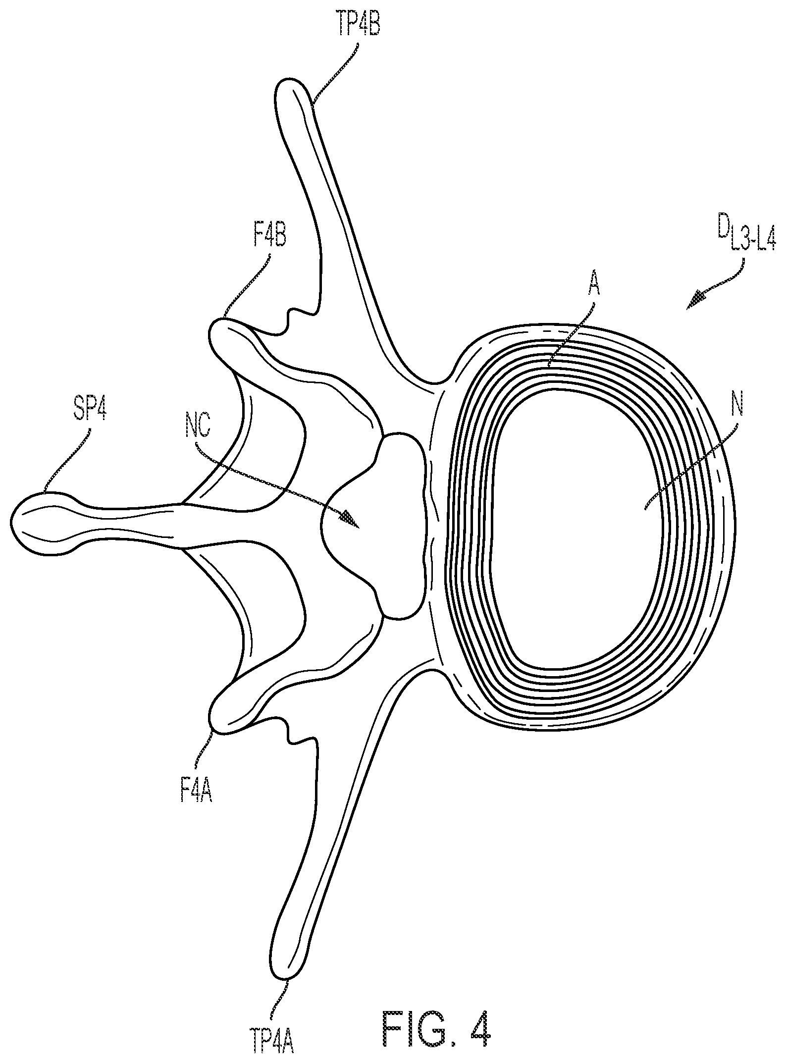 Patent US12472075 Figure 4 – Expandable intervertebral fusion implant