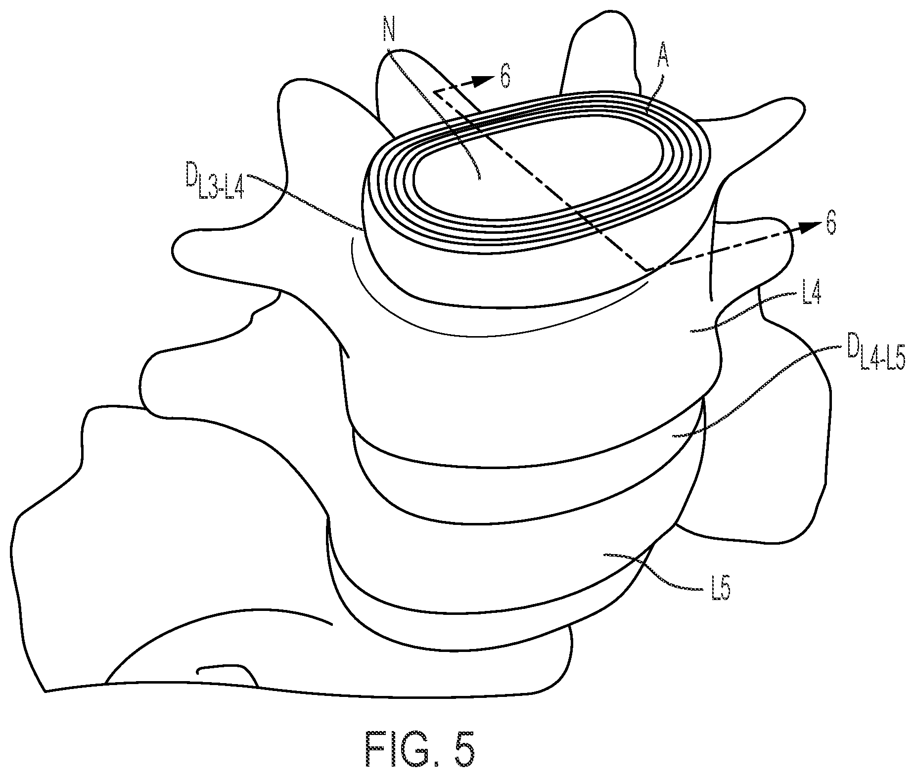 Patent US12472075 Figure 5 – Expandable intervertebral fusion implant