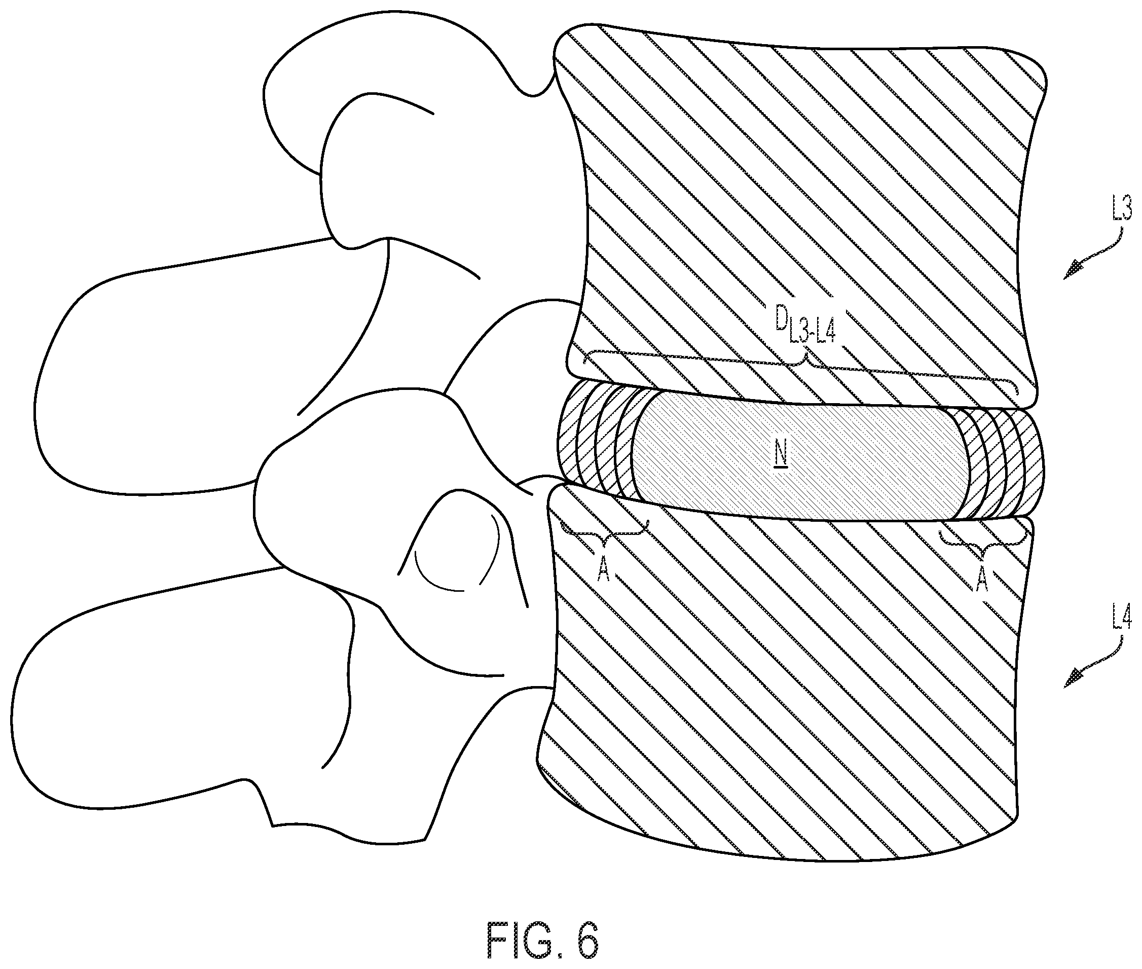 Patent US12472075 Figure 6 – Expandable intervertebral fusion implant
