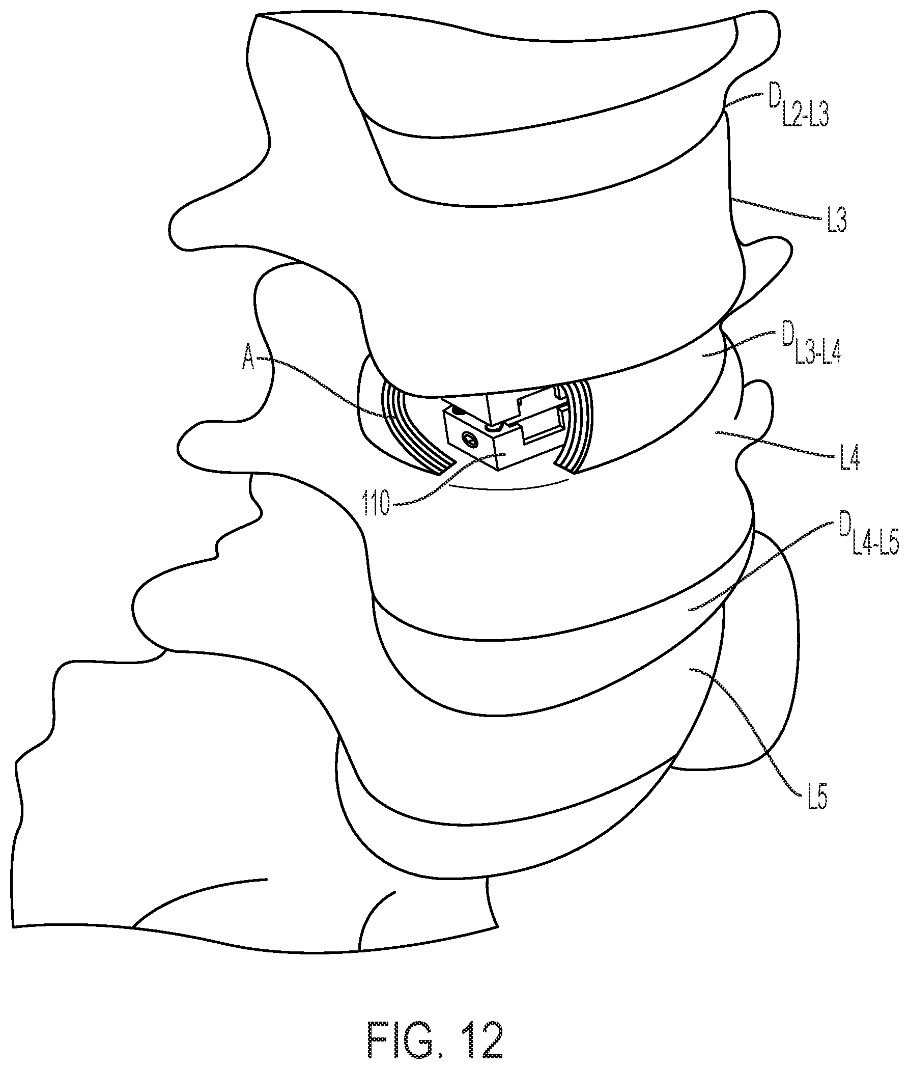 Patent US12472075 Figure 13 – Expandable intervertebral fusion implant