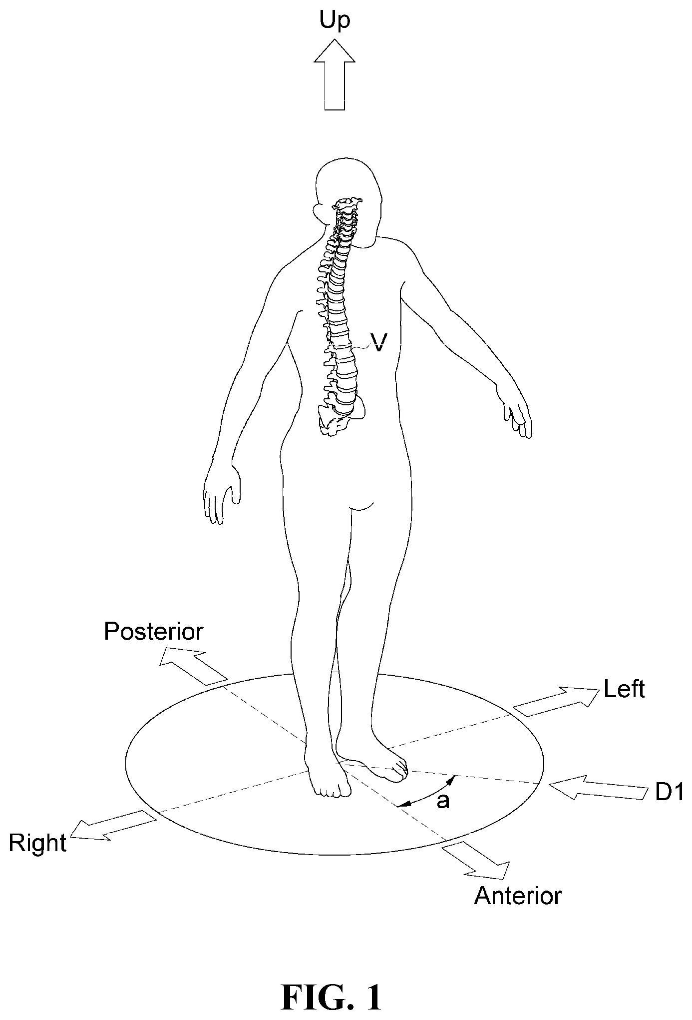 Patent US12472076 Figure 1 – Oblique lateral insertion-type intervertebral cage