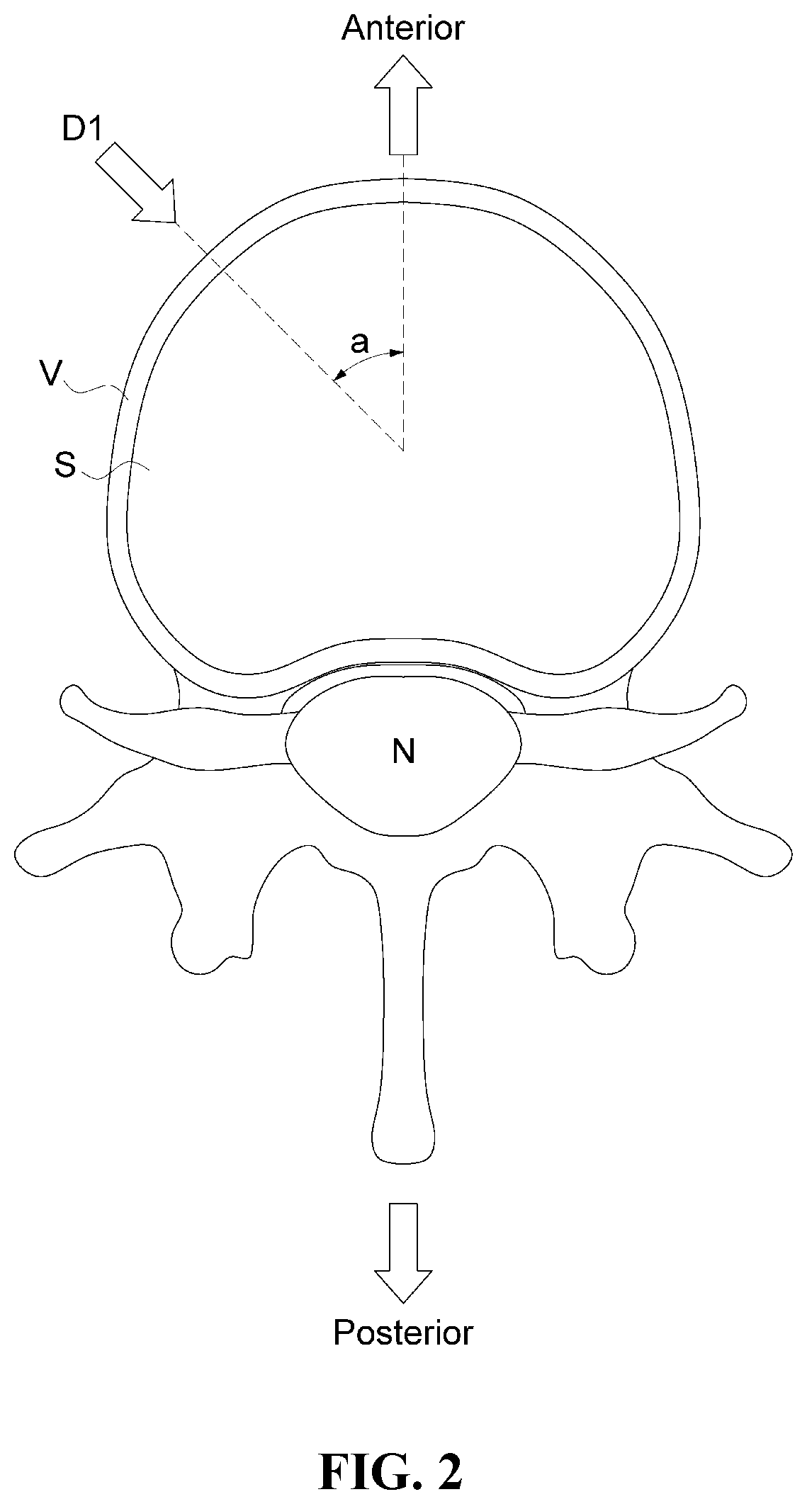 Patent US12472076 Figure 2 – Oblique lateral insertion-type intervertebral cage