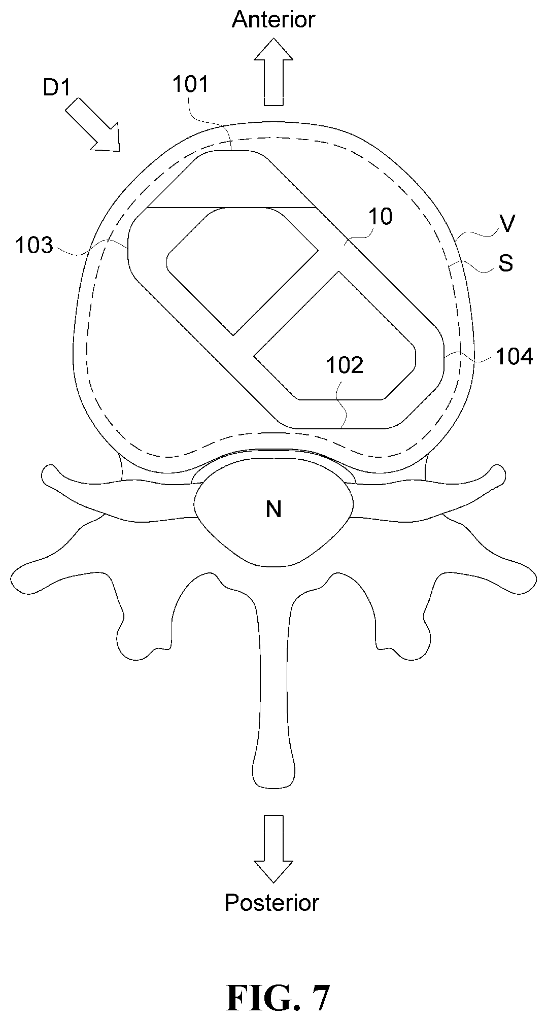 Patent US12472076 Figure 7 – Oblique lateral insertion-type intervertebral cage