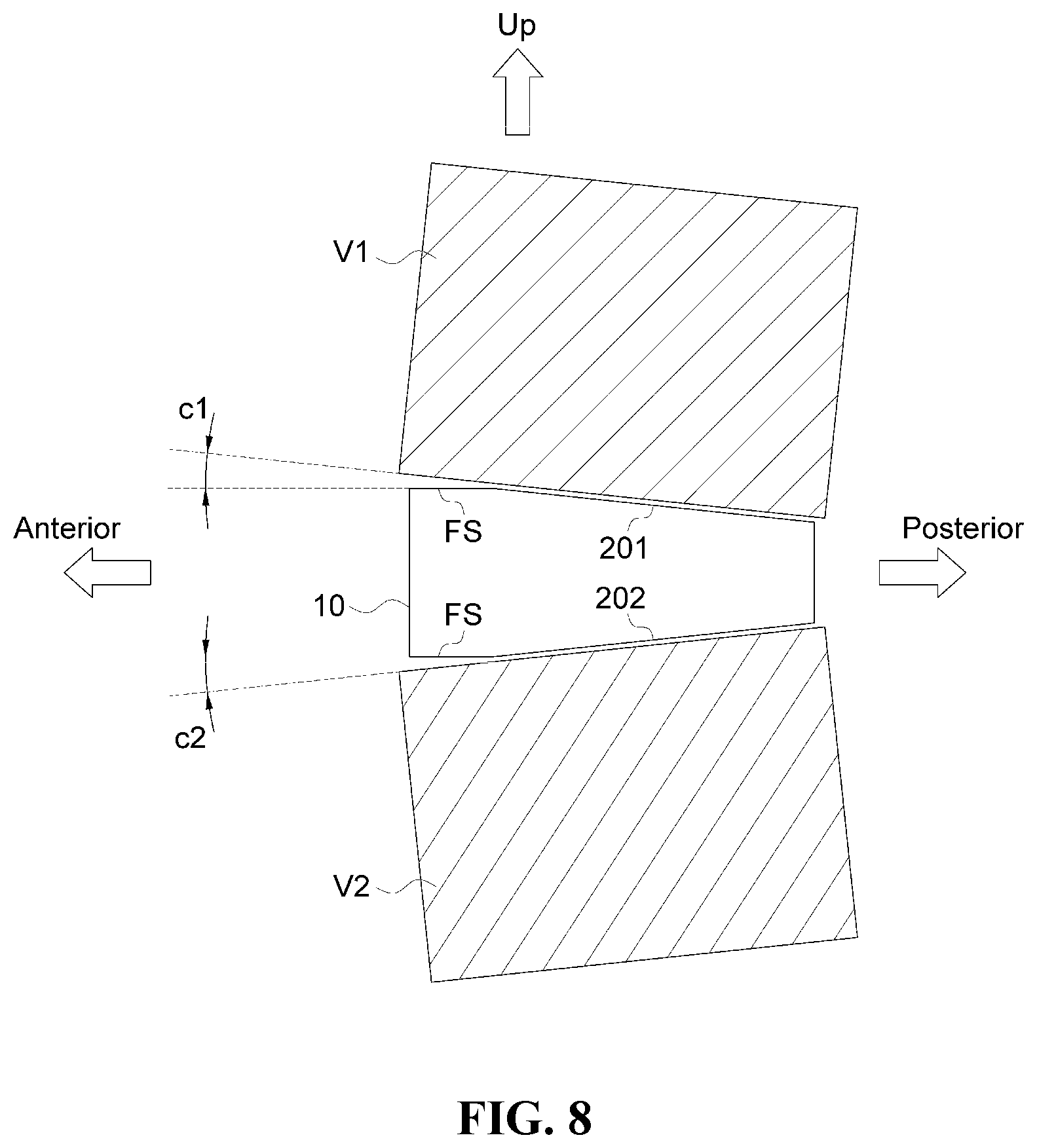 Patent US12472076 Figure 8 – Oblique lateral insertion-type intervertebral cage