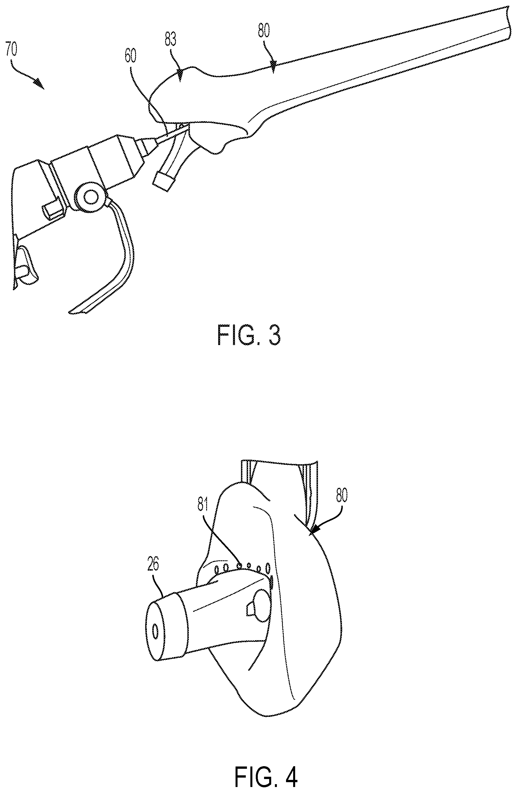 Patent US12472078 Figure 3 – Intramedullary prosthesis removal systems and methods thereof