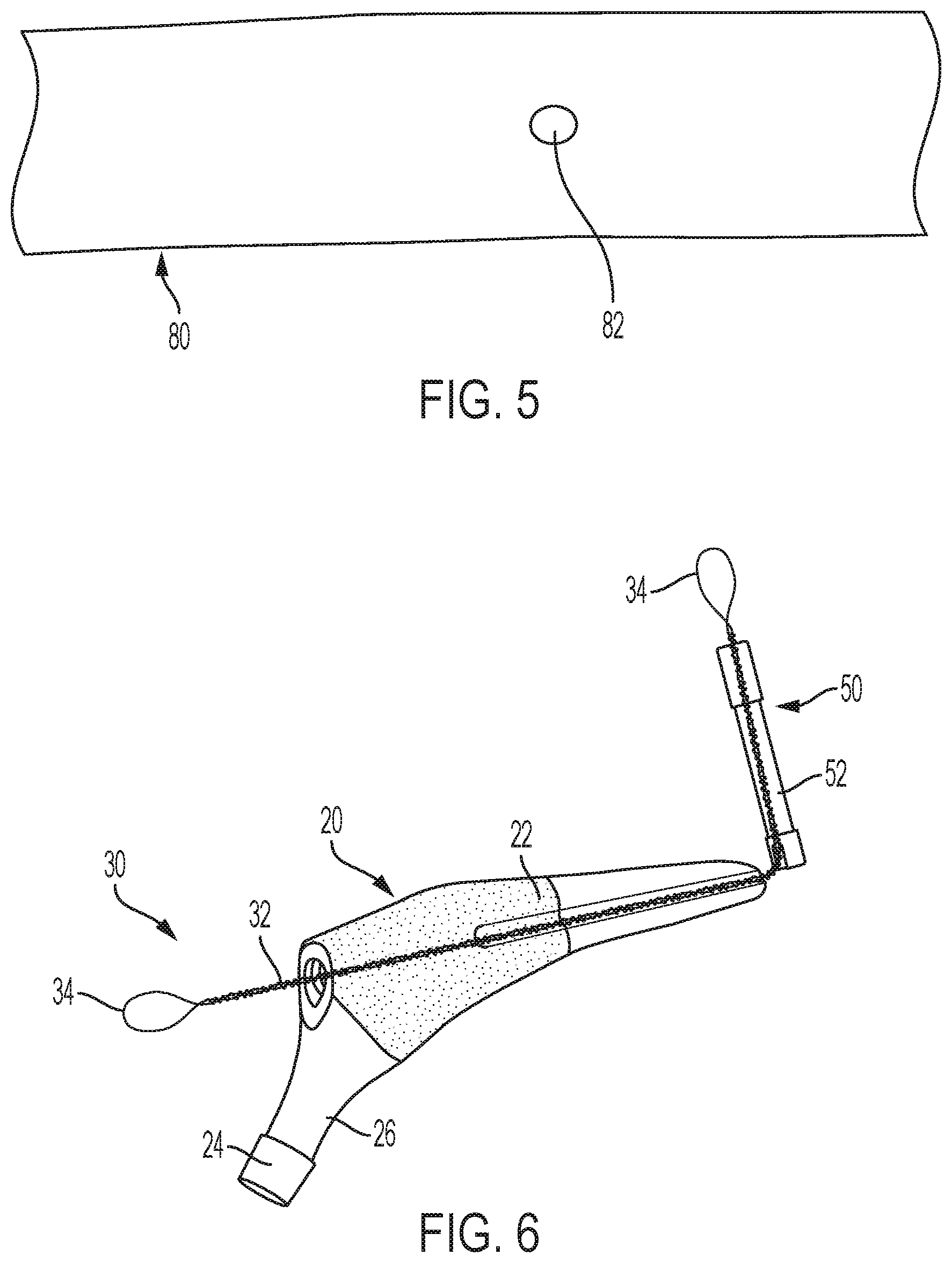 Patent US12472078 Figure 4 – Intramedullary prosthesis removal systems and methods thereof