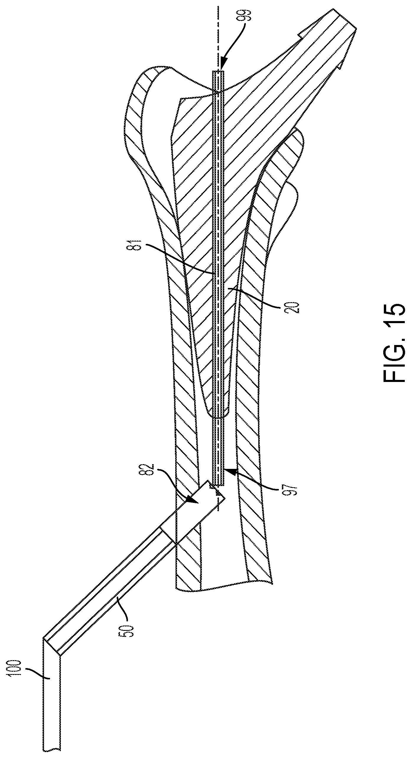 Patent US12472078 Figure 12 – Intramedullary prosthesis removal systems and methods thereof