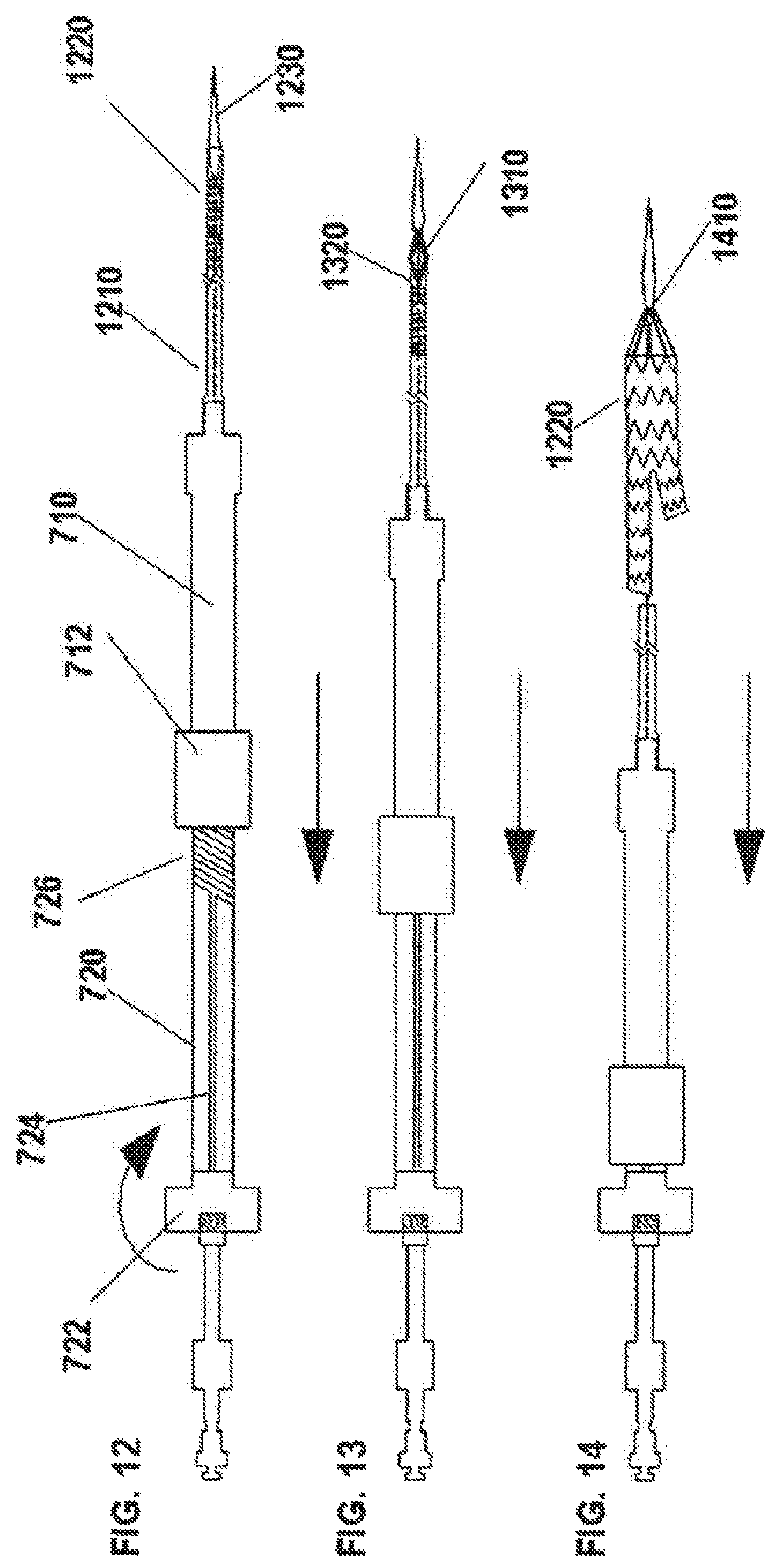 Patent US12472081 Figure 4 – Abdominal aortic aneurysms: systems and methods of use