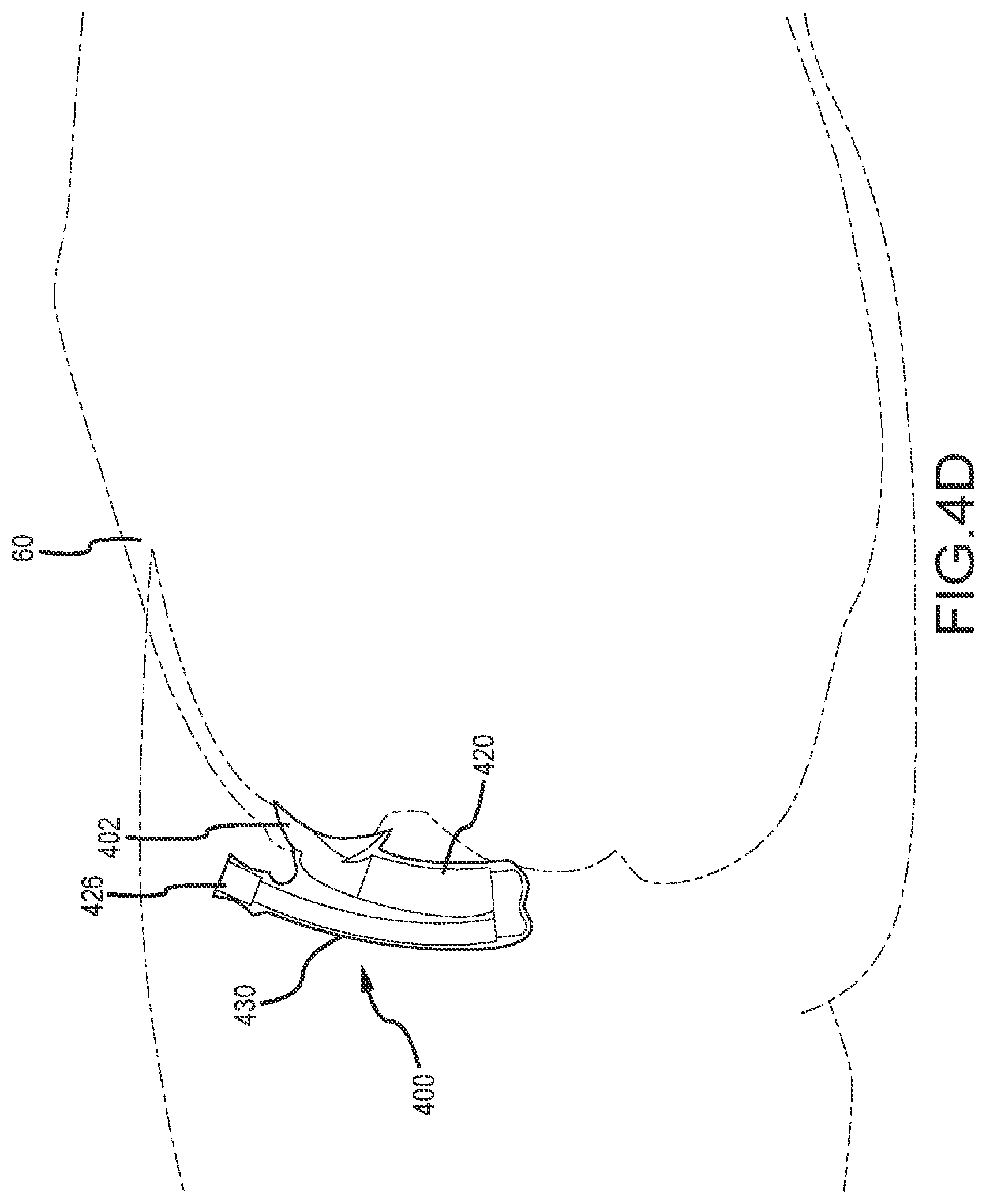 Patent US12472090 Figure 6 – Female external catheter devices having a urethral cup, and related systems and methods