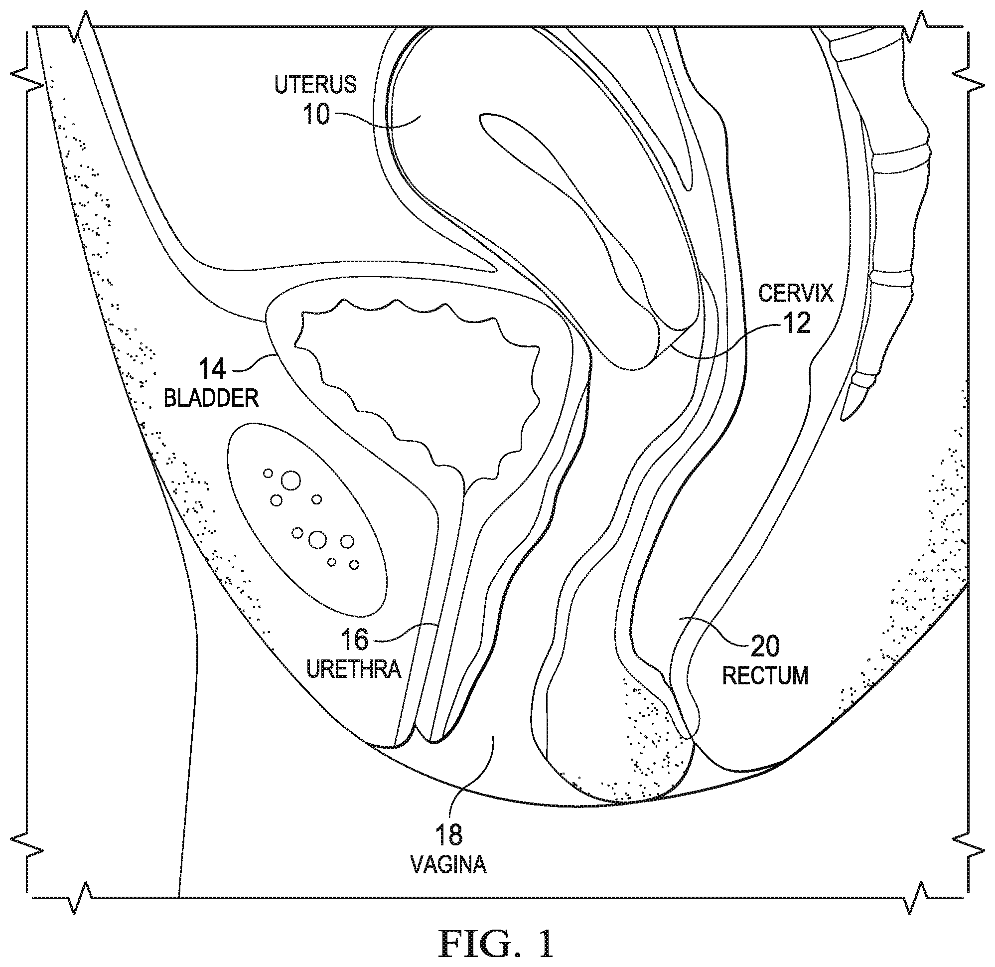 Patent US12472092 Figure 1 – Flexible cone-shaped intra-vaginal support device